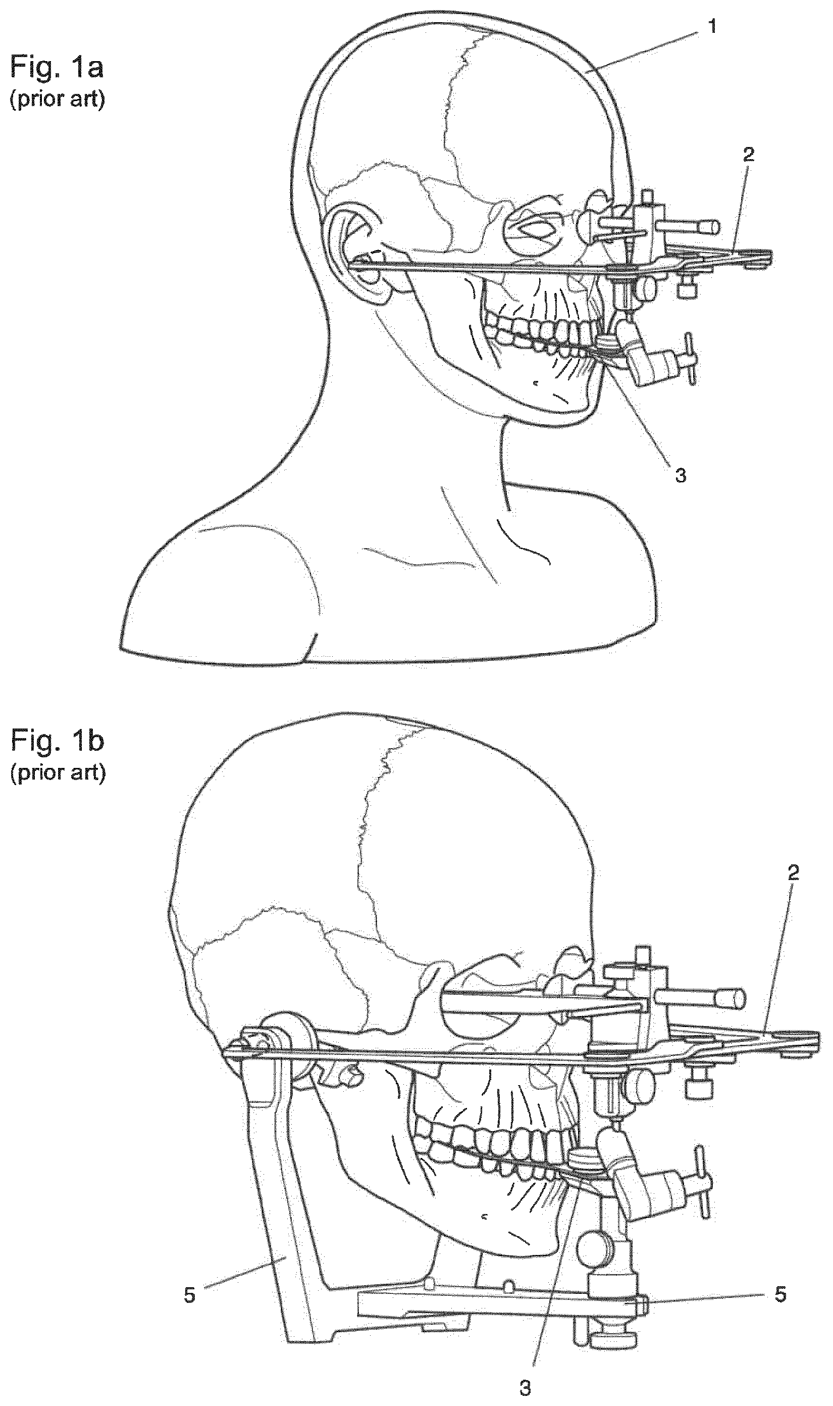 Patent US12396828 Figure 1 – Method for providing a 3D-print data set of a dental model structure, computer program product, dental model structure, mounting plate and dental model system