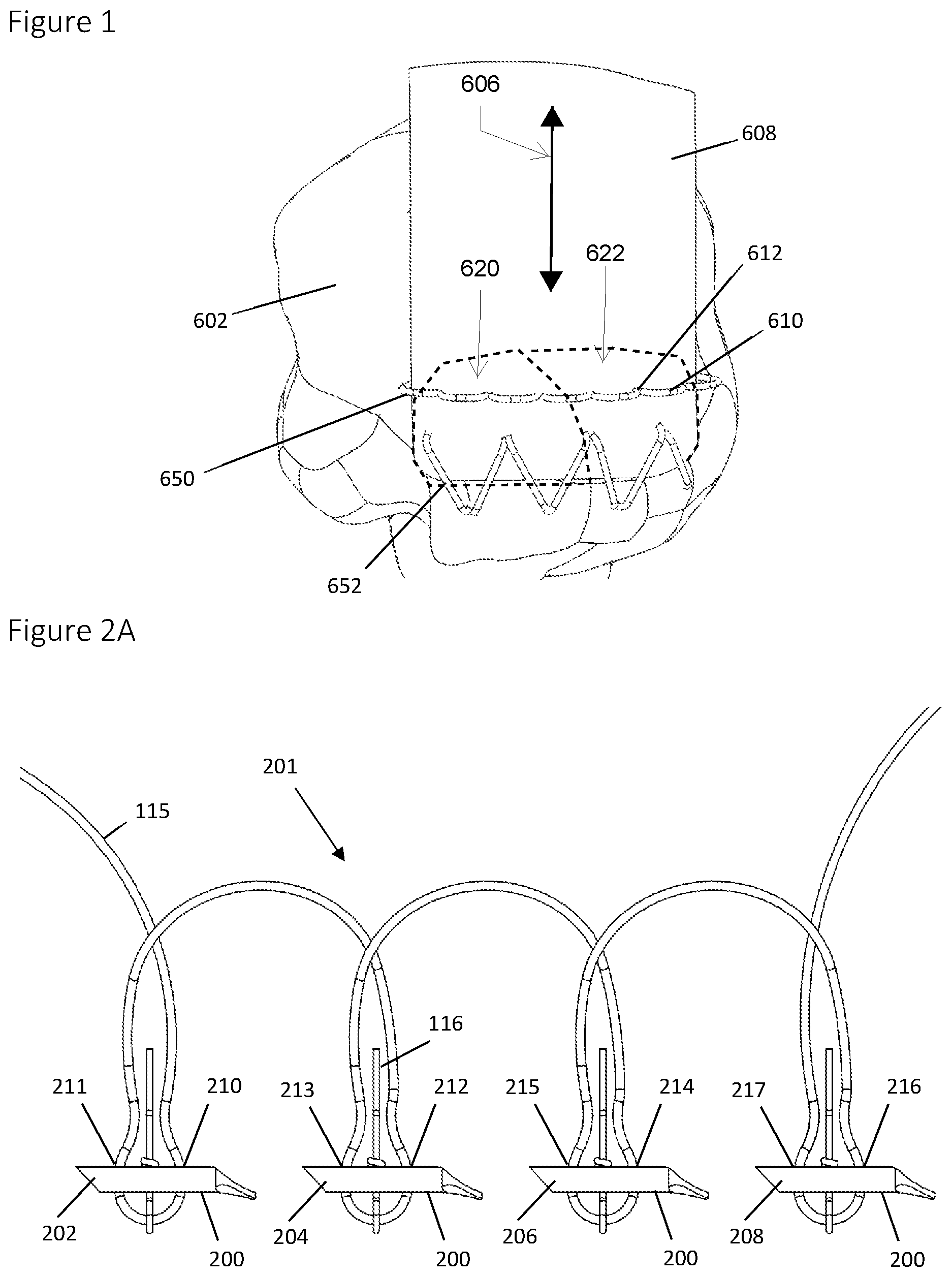 Patent US12396839 — Method and apparatus for creating a seam-like anatomical low creep attachment of soft tissue to bone — Figure 1