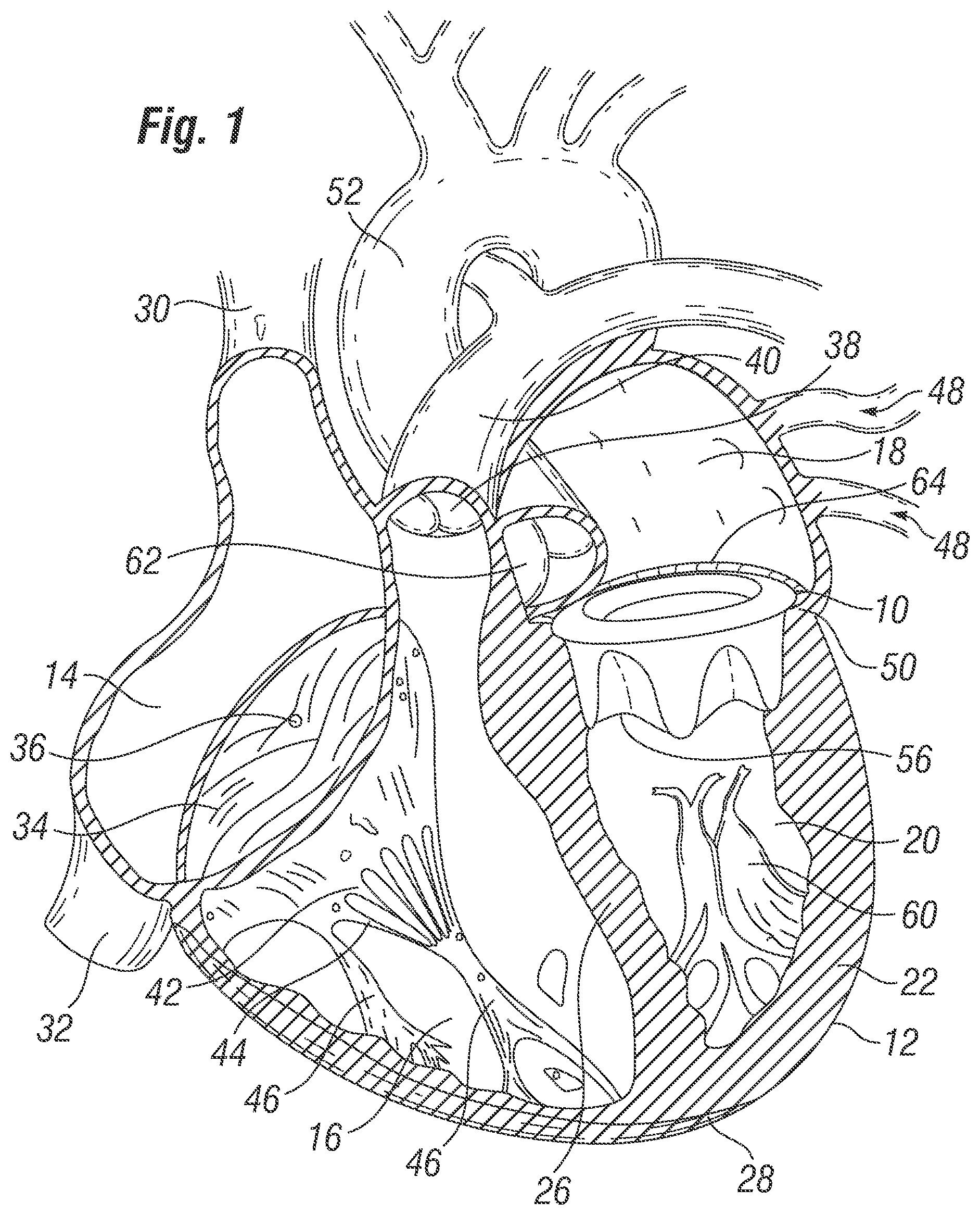 Patent US12396846 Figure 1 – Methods of implanting a prosthetic heart valve within another