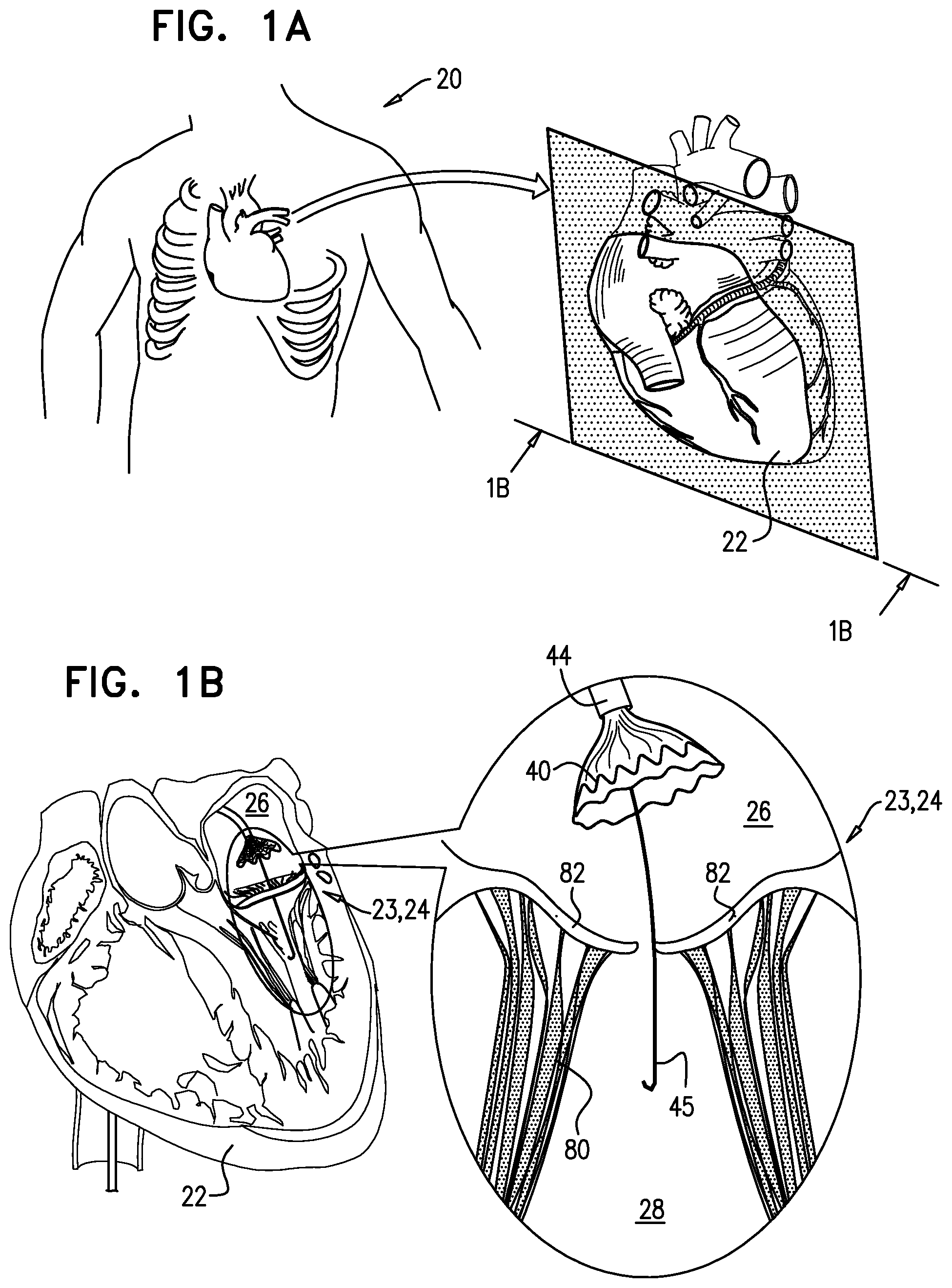 Patent US12396848 Figure 1 – Method for use at a heart valve