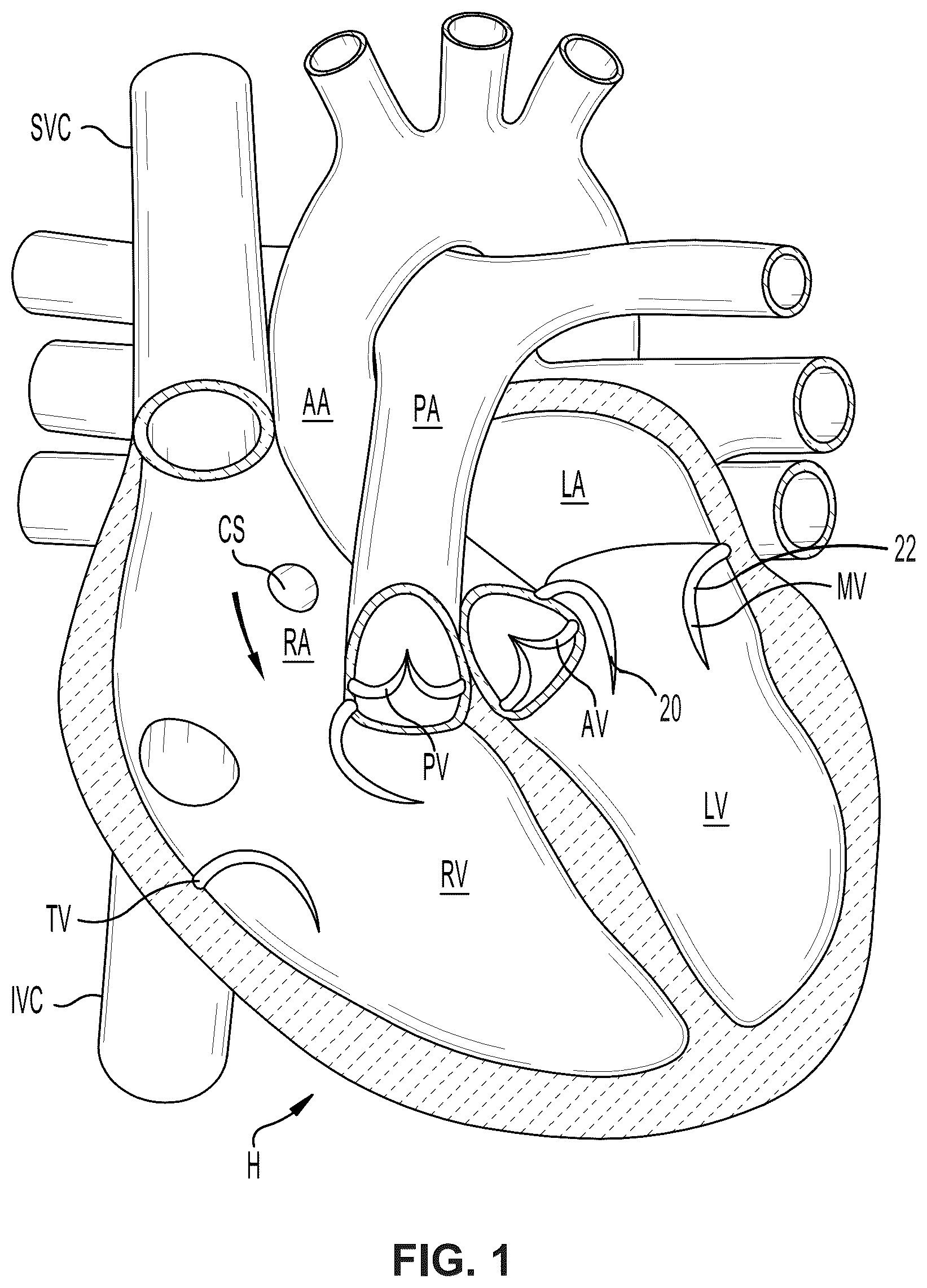 Patent US12396850 — Catheterization method and apparatus — Figure 1