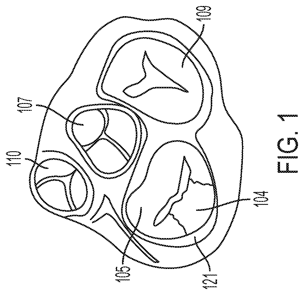 Patent US12396853 Figure 1 – Systems and methods for delivery of chordae replacement system