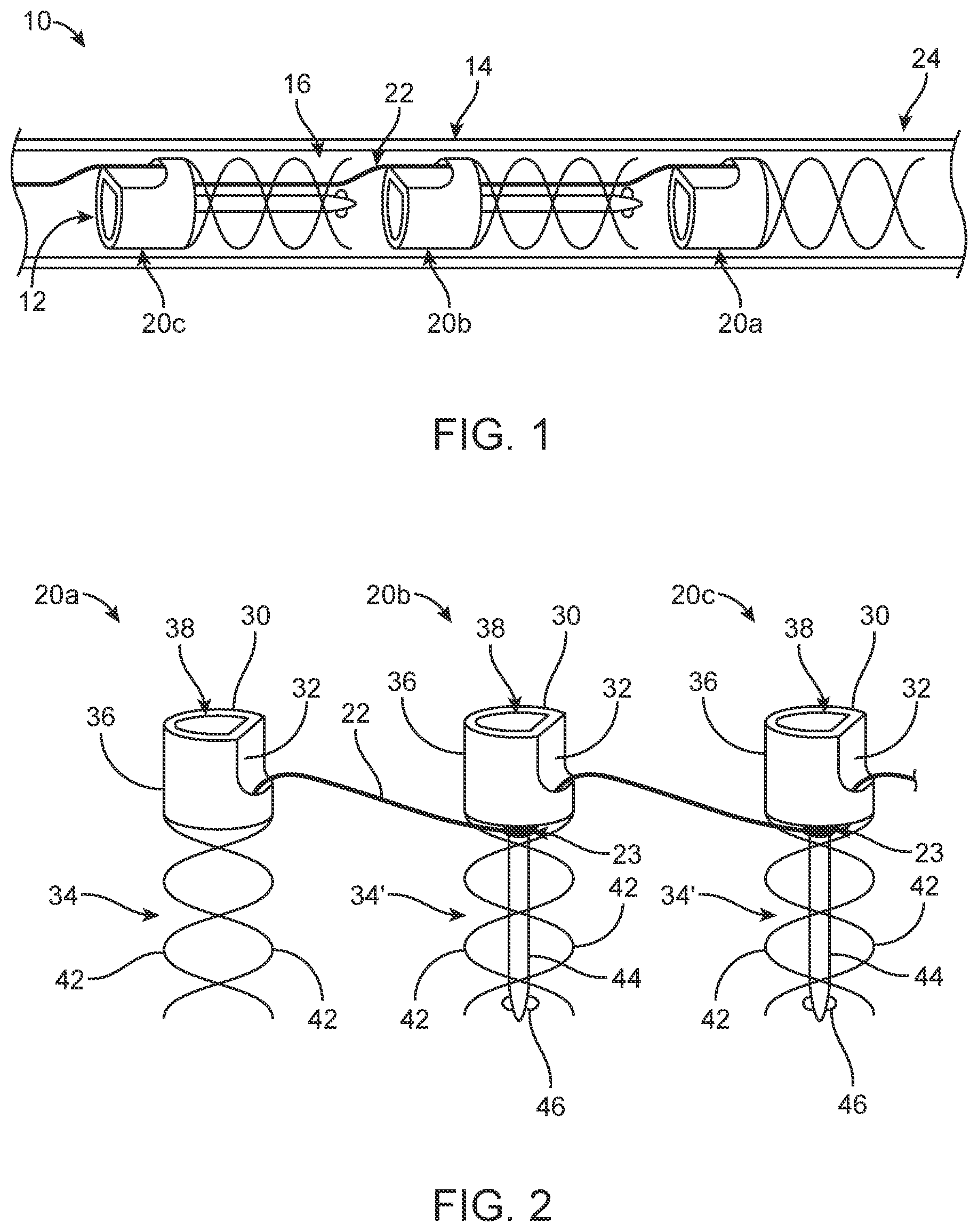 Patent US12396854 — Systems, devices and methods for reshaping a bodily lumen — Figure 1