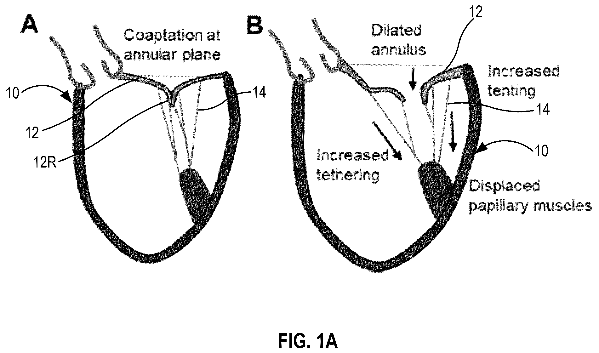 Patent US12396855 — Systems, devices, and methods for reducing heart valve regurgitation — Figure 1
