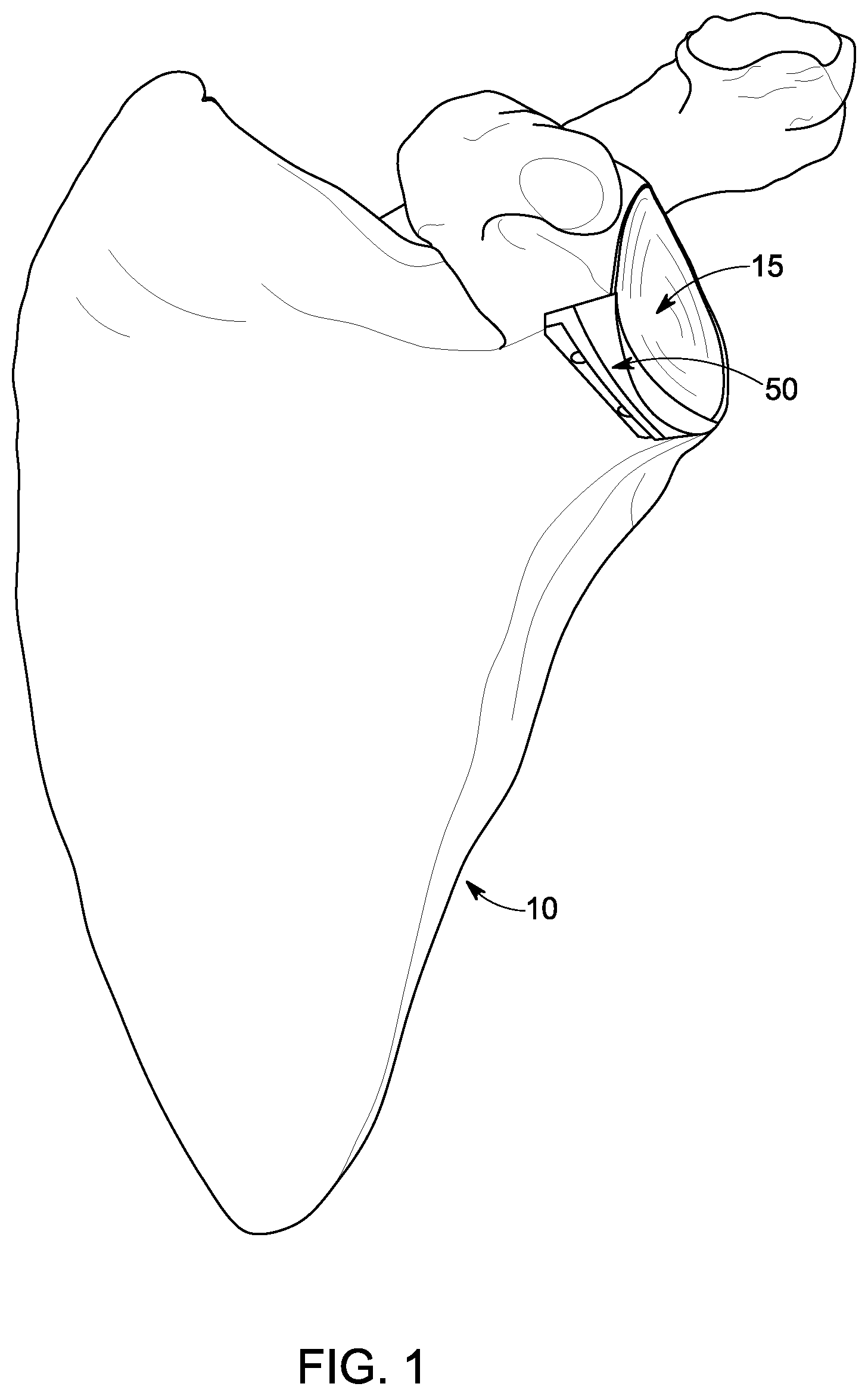 Patent US12396861 — Implant systems for repair of a glenoid cavity — Figure 1