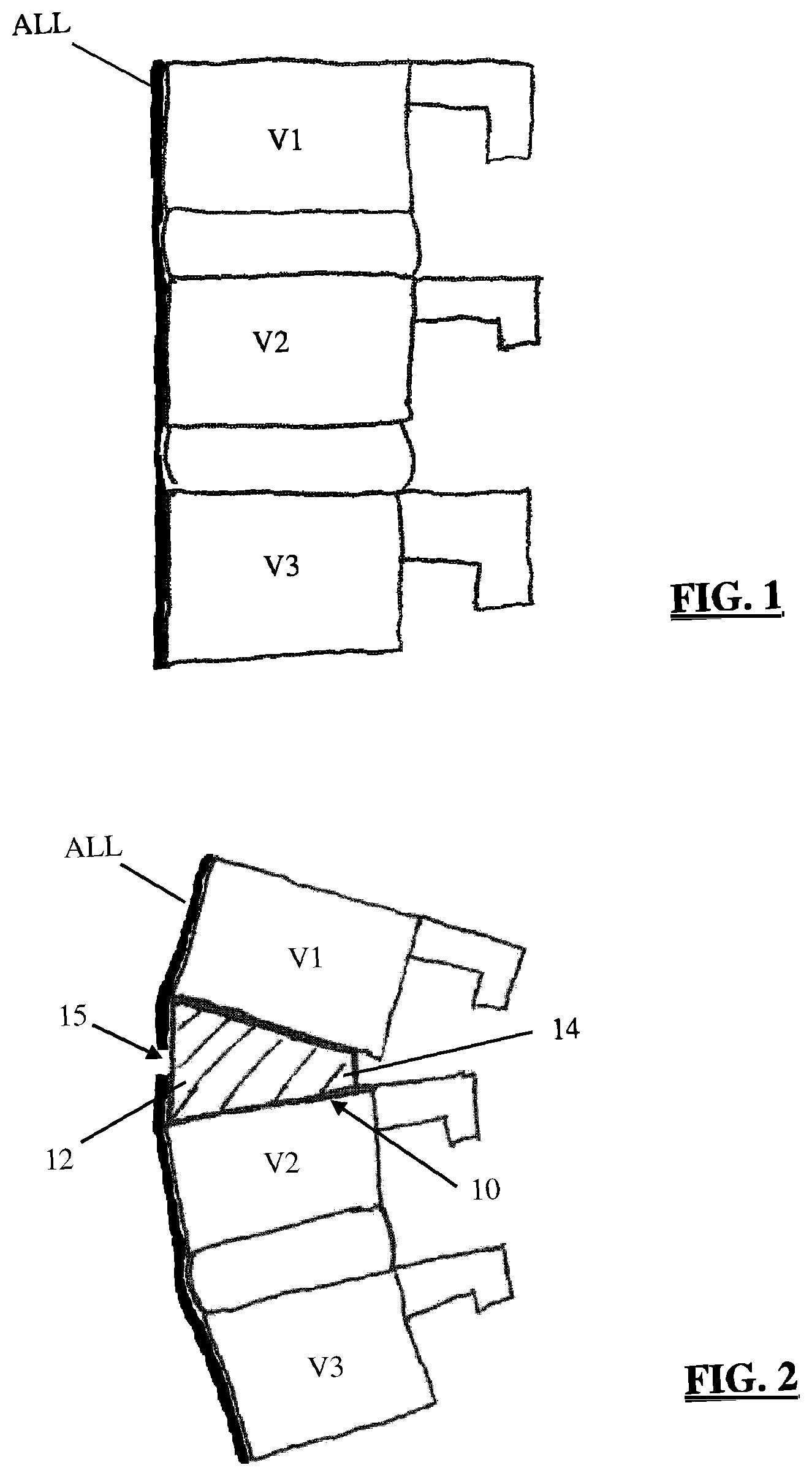 Patent US12396863 — Methods and apparatus for performing spine surgery — Figure 1