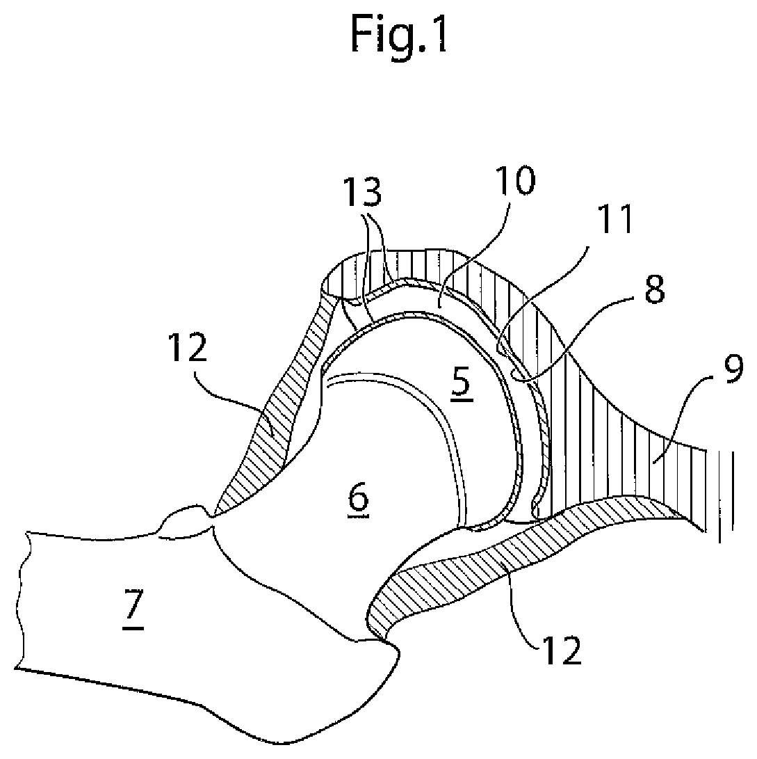 Patent US12396868 — Hip joint instrument and method — Figure 1