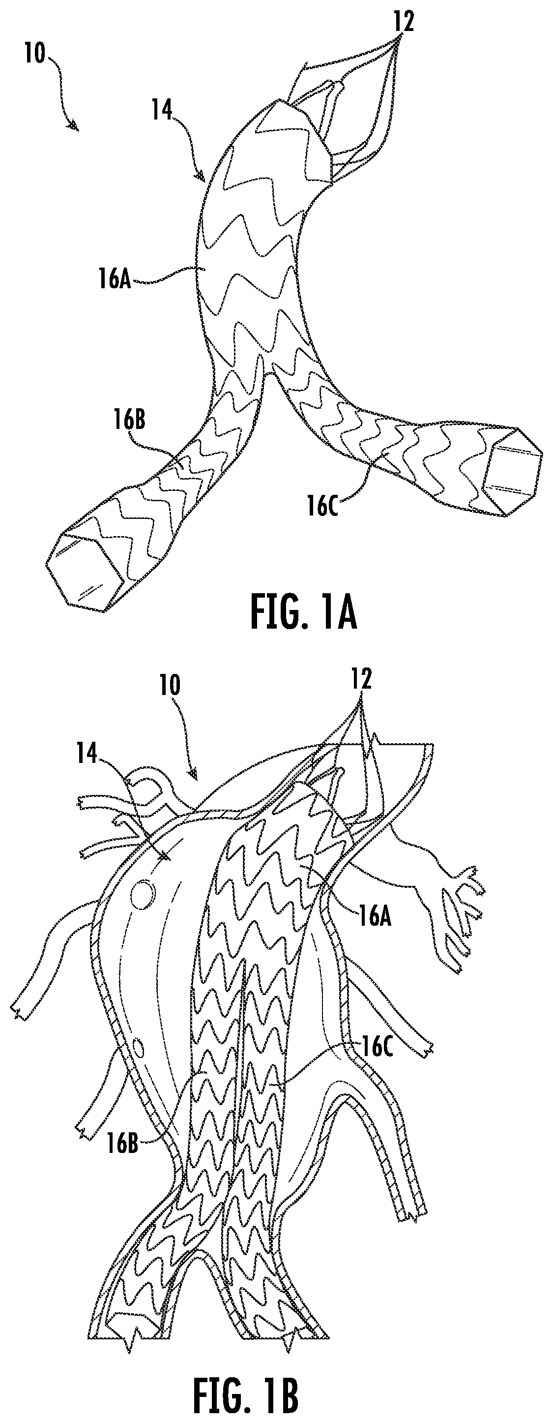 Patent US12396871 — Devices and methods for stent graft extraction — Figure 1
