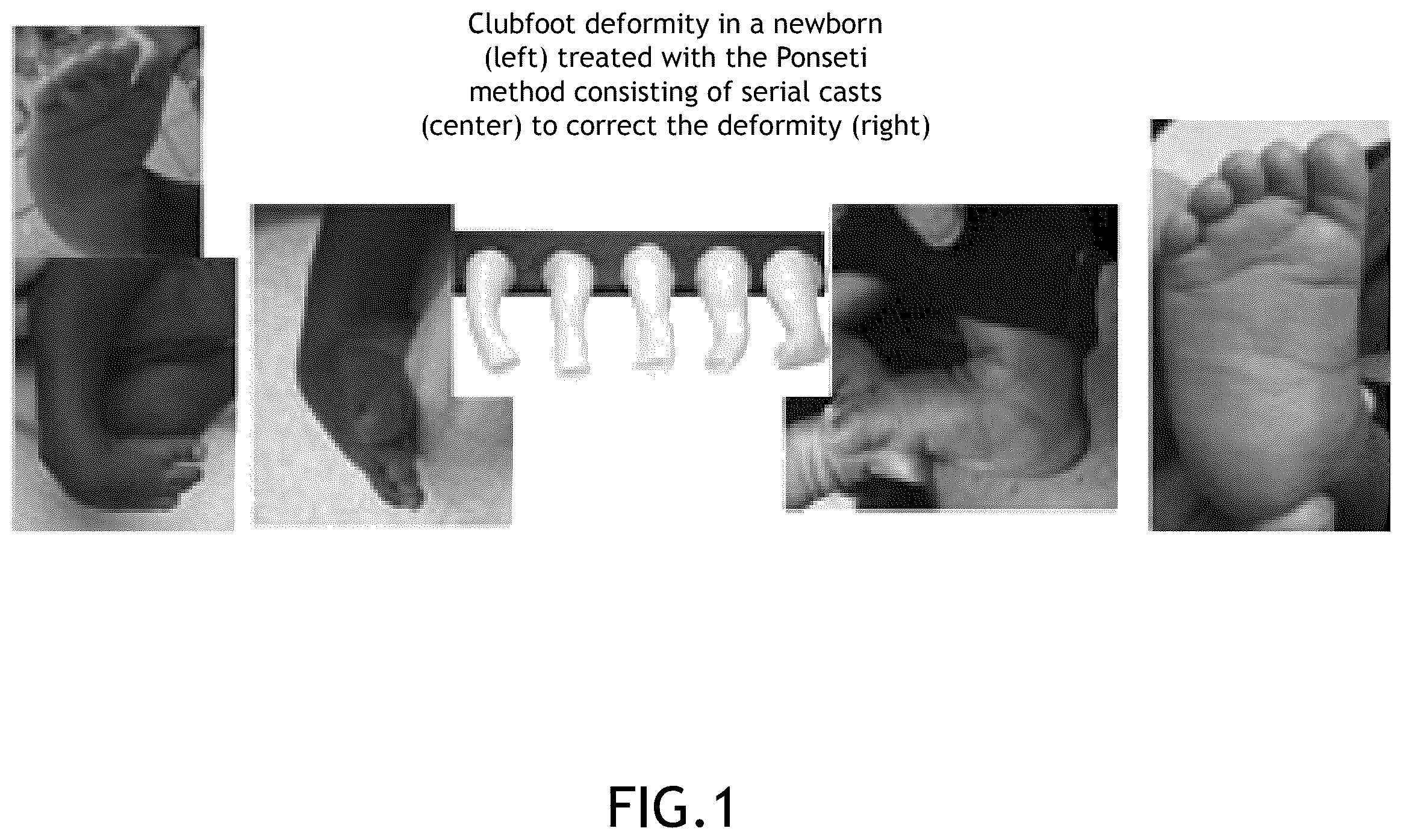 Patent US12396878 — Smart corrective alignment foot brace — Figure 1