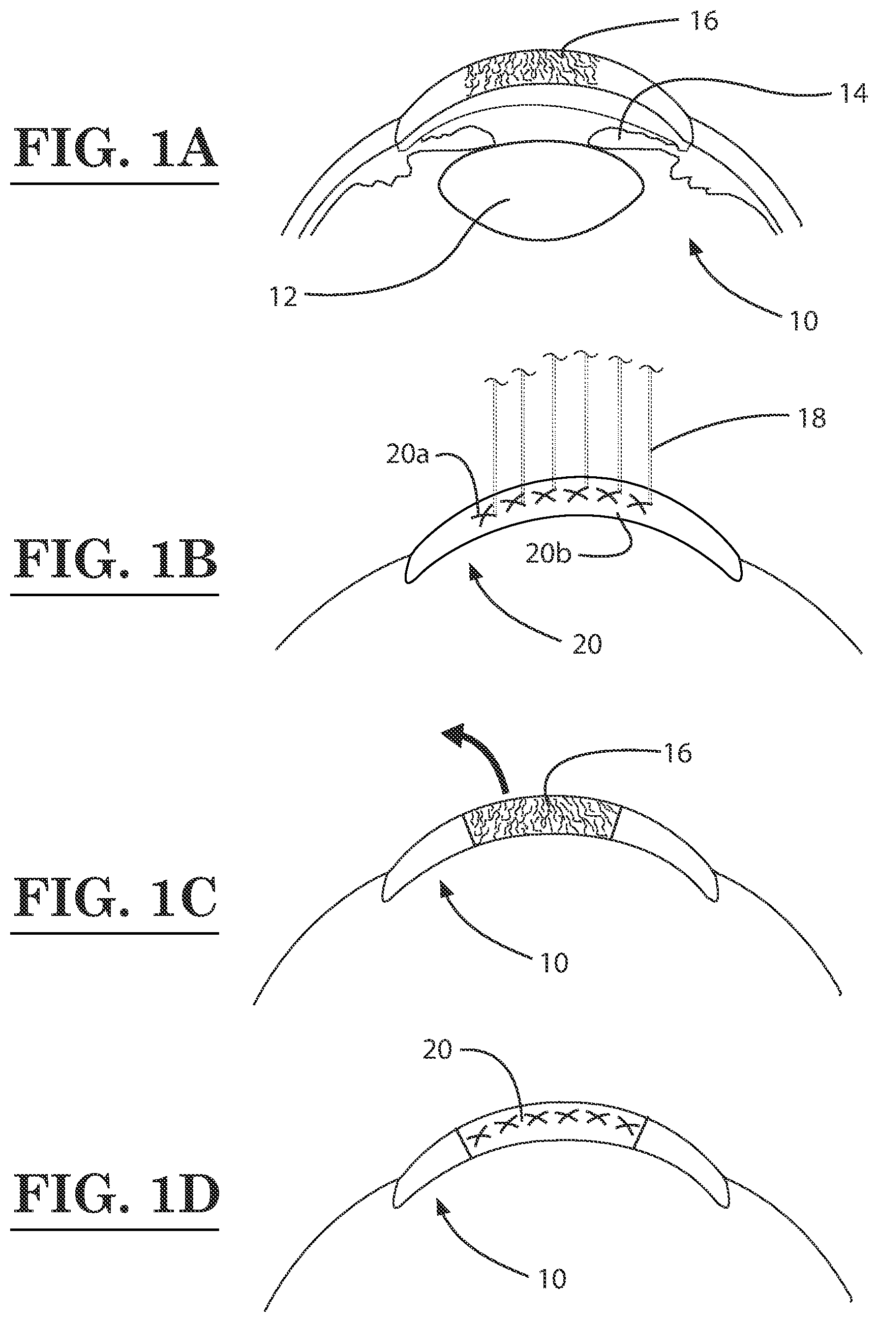 Patent US12396889 — Lamellar corneal autologous or homologous graft in refractive surgery — Figure 1
