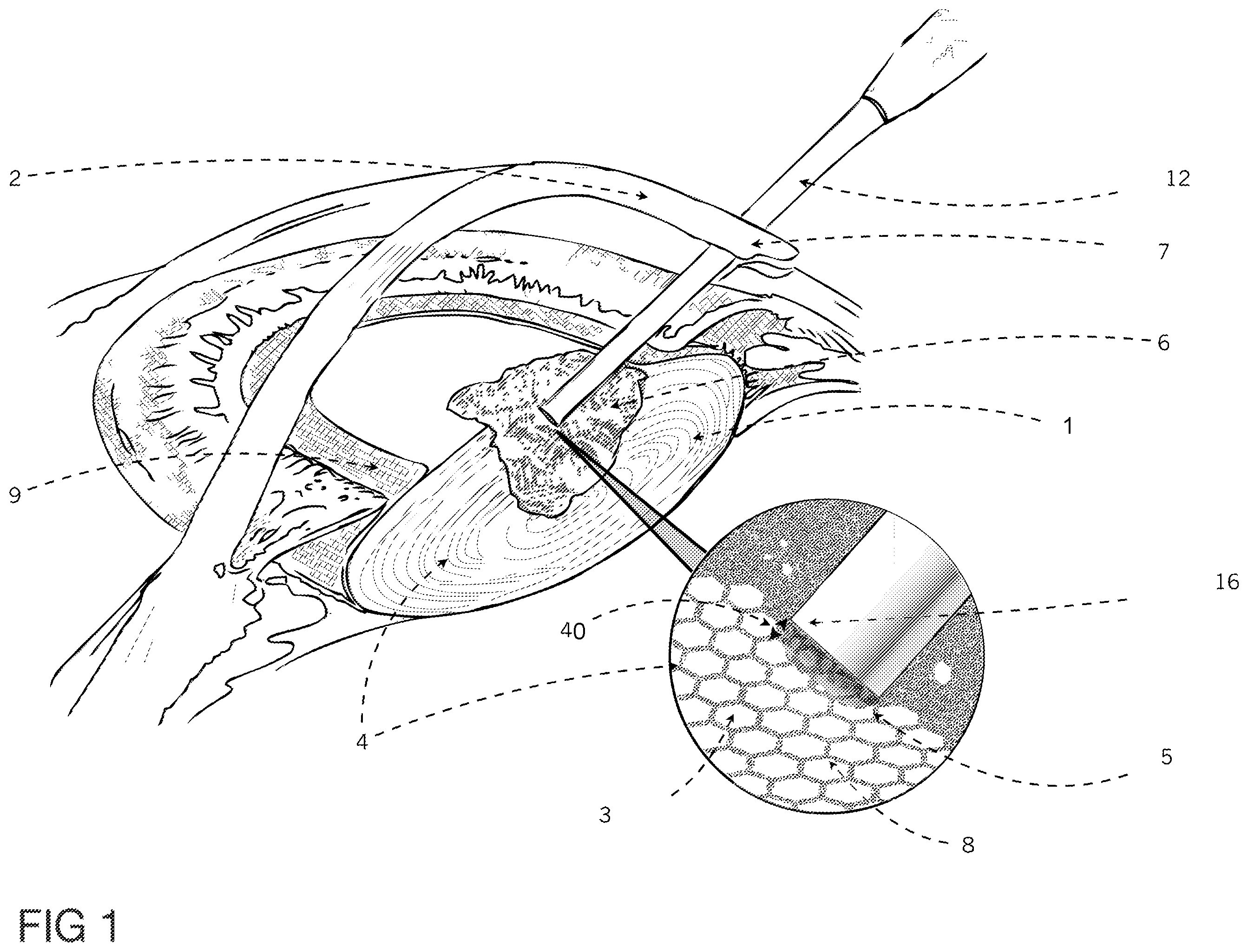 Patent US12396891 — Laser apparatus for treatment of a cataractous lens — Figure 1