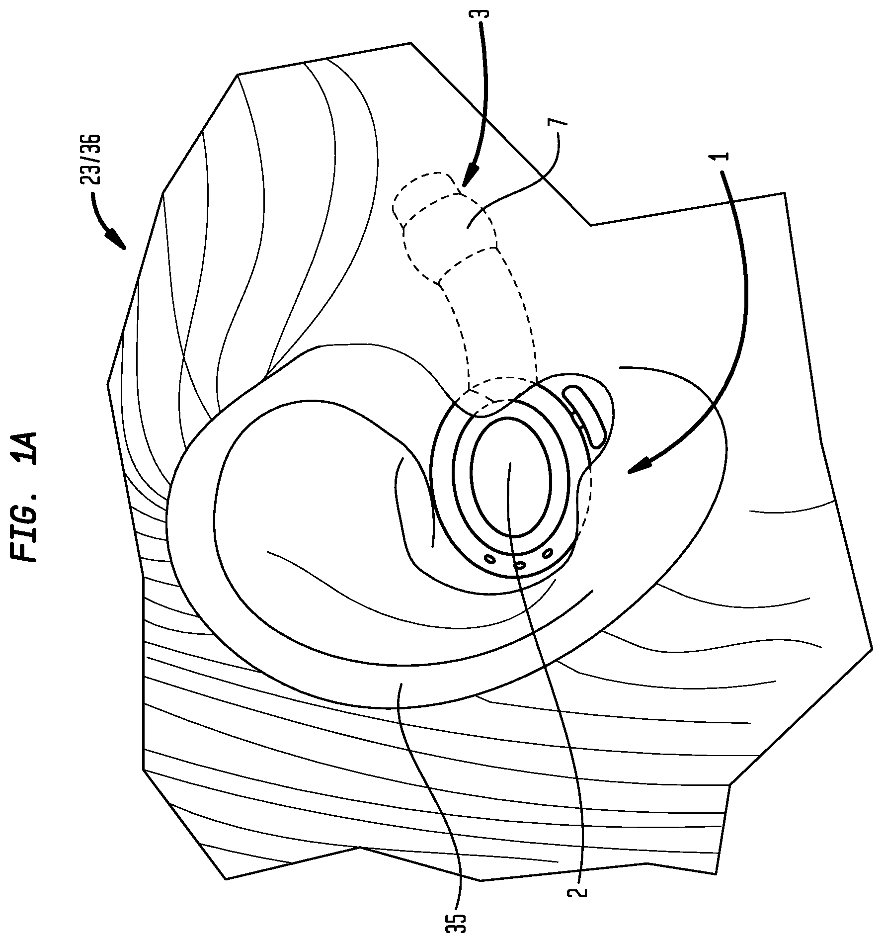 Patent US12396892 — External ear canal pressure regulation device — Figure 1