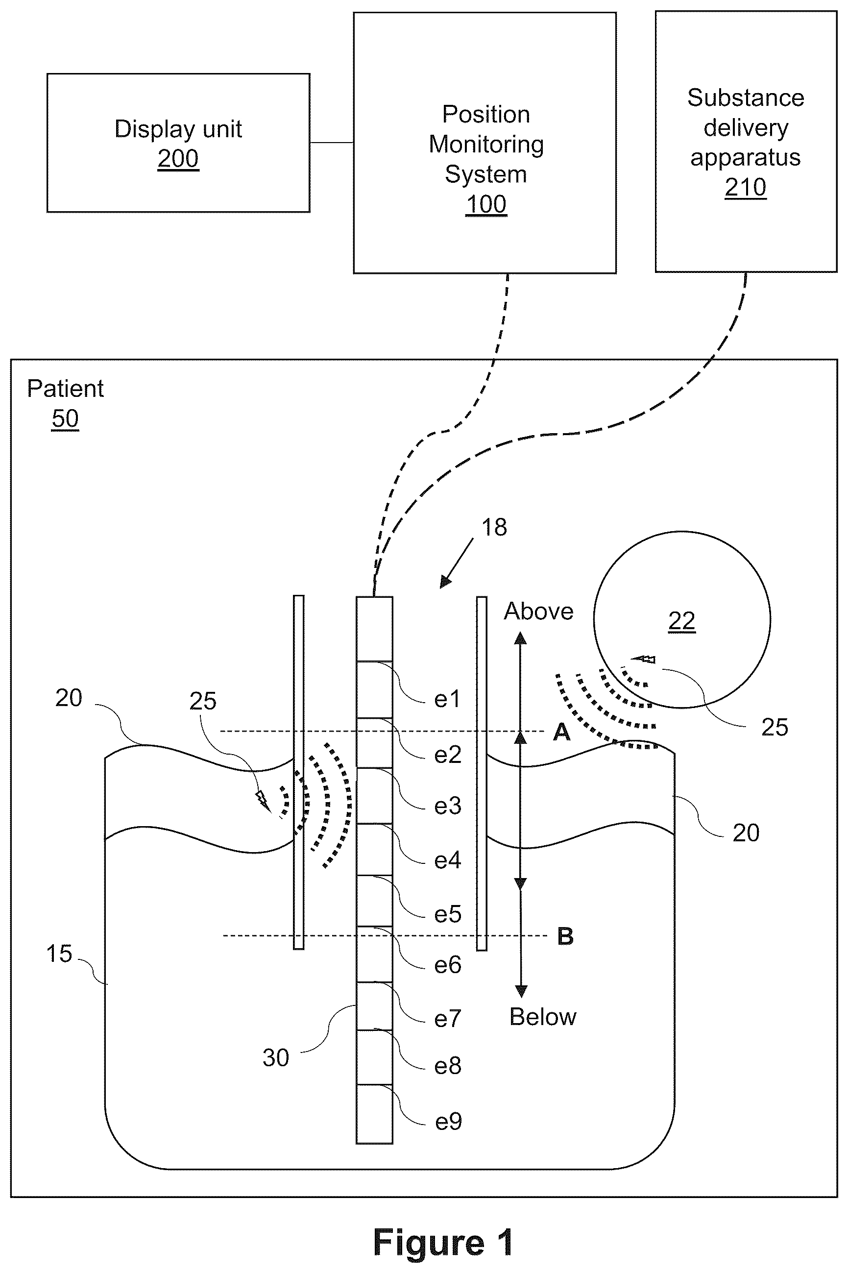 Patent US12396927 — Classifying of a position of a catheter in relation to a diaphragm — Figure 1