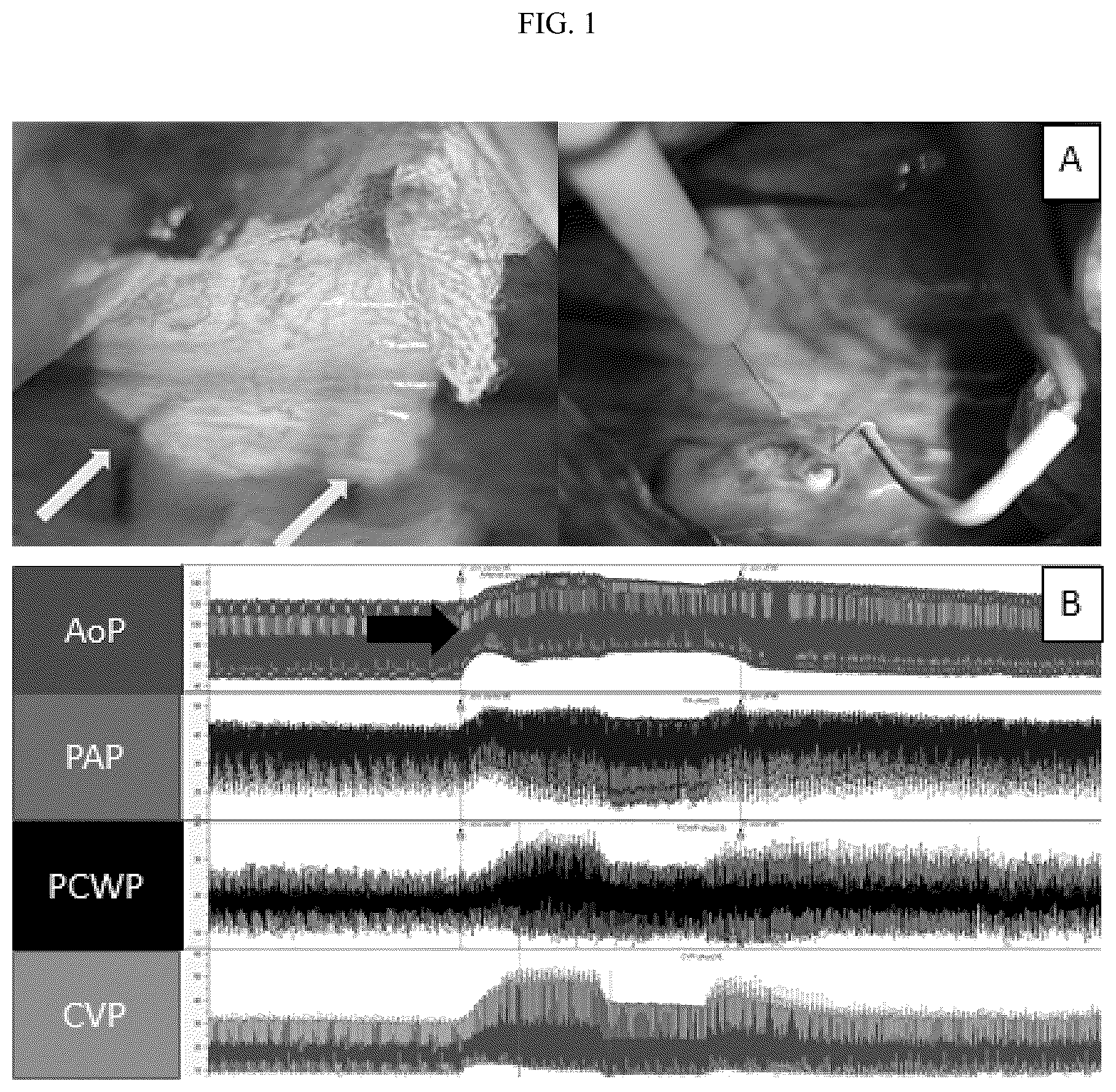 Patent US12396998 — Treatment for heart failure with preserved ejection fraction with guanethidine and guanadrel — Figure 1