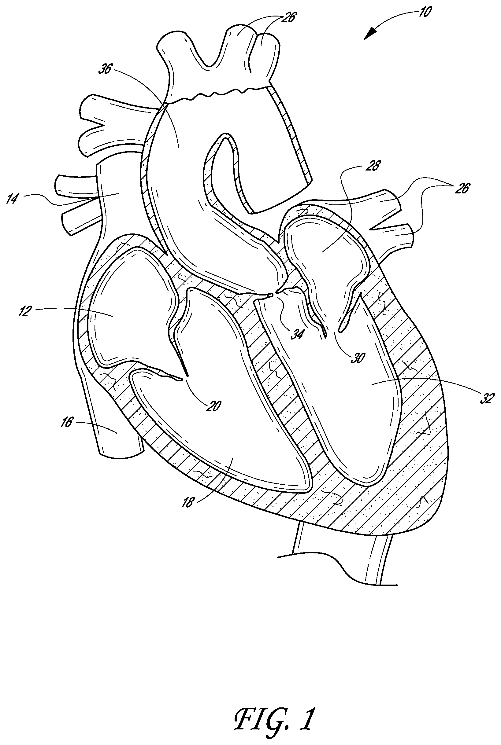 Patent US12403007 — Prosthetic implant delivery device with introducer catheter — Figure 1