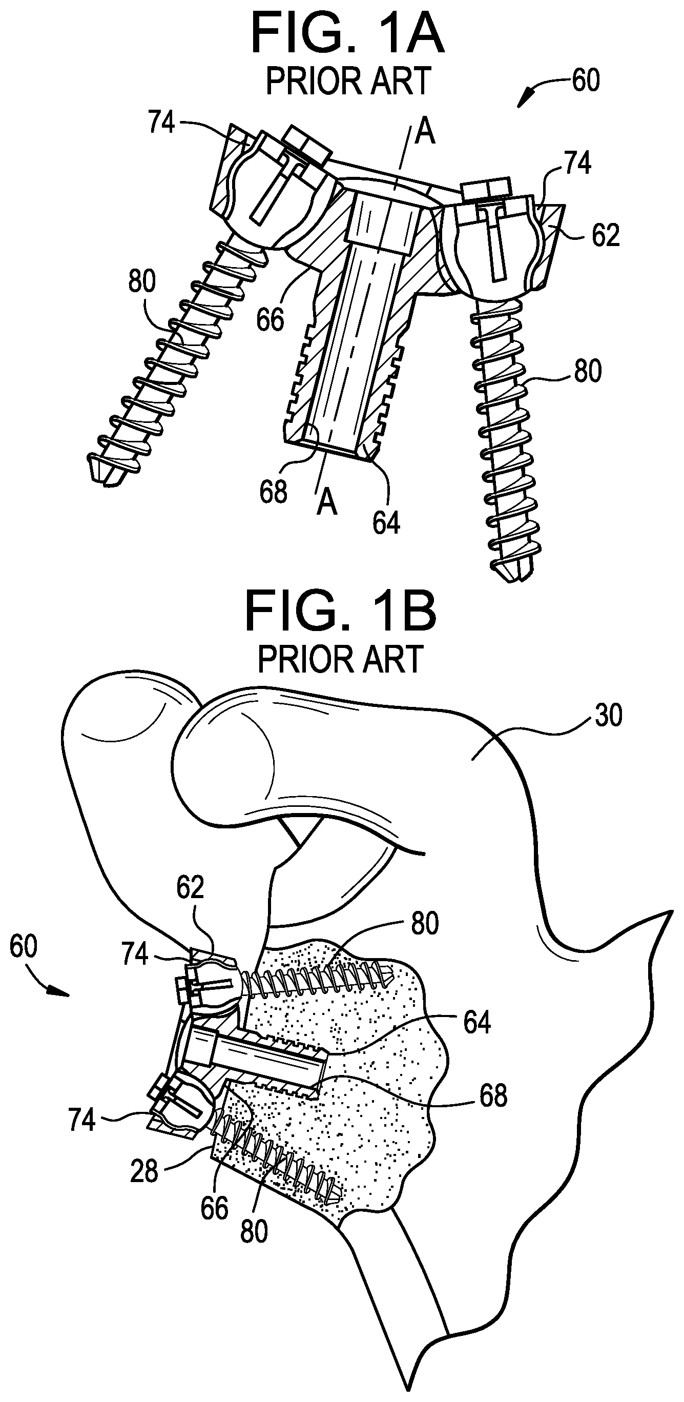 Patent US12403011 Figure 1 – Baseplate of a modular shoulder joint prosthesis and related methods for implanting the same