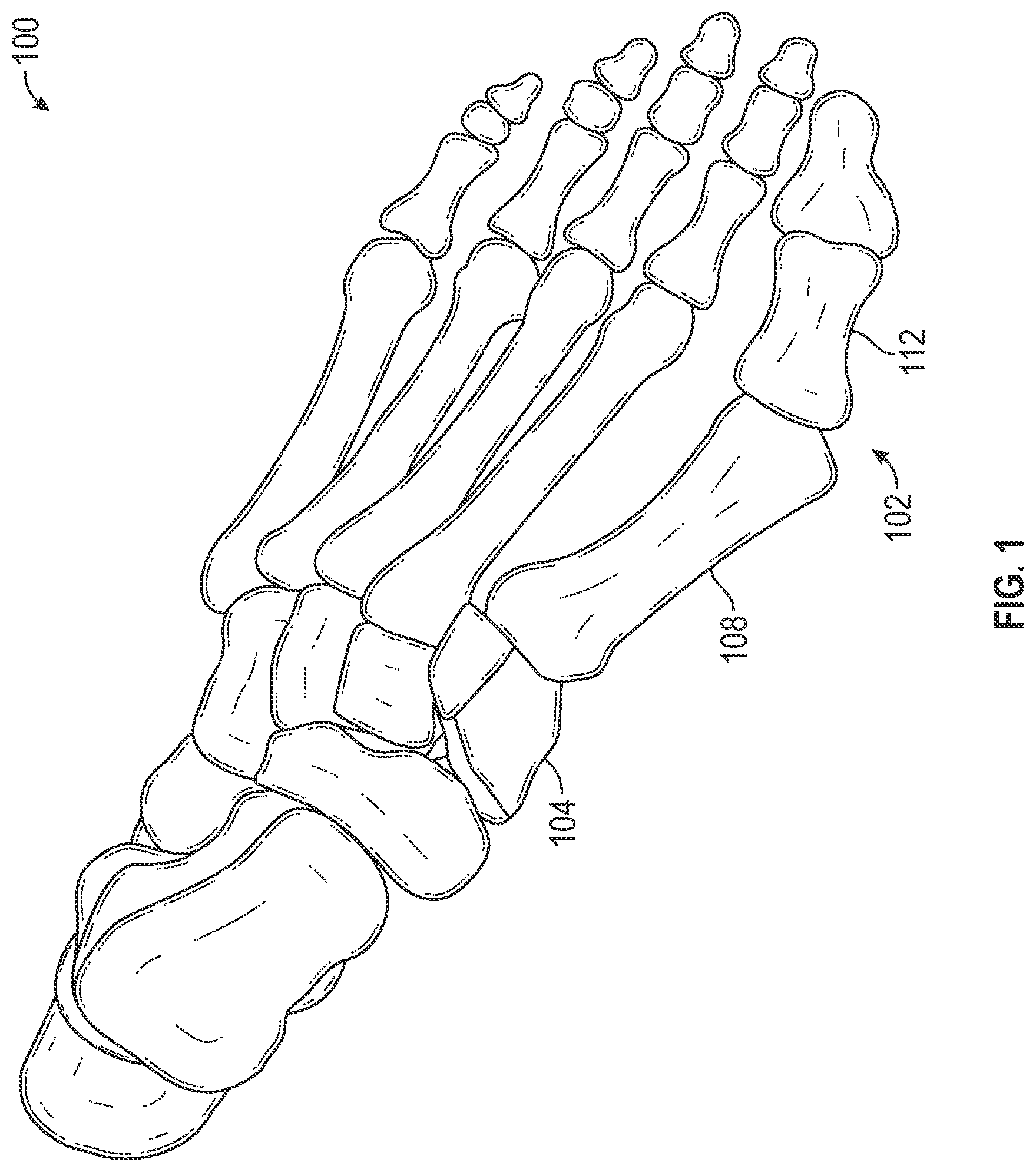 Patent US12403012 — Bone repositioning guide system and procedure — Figure 1