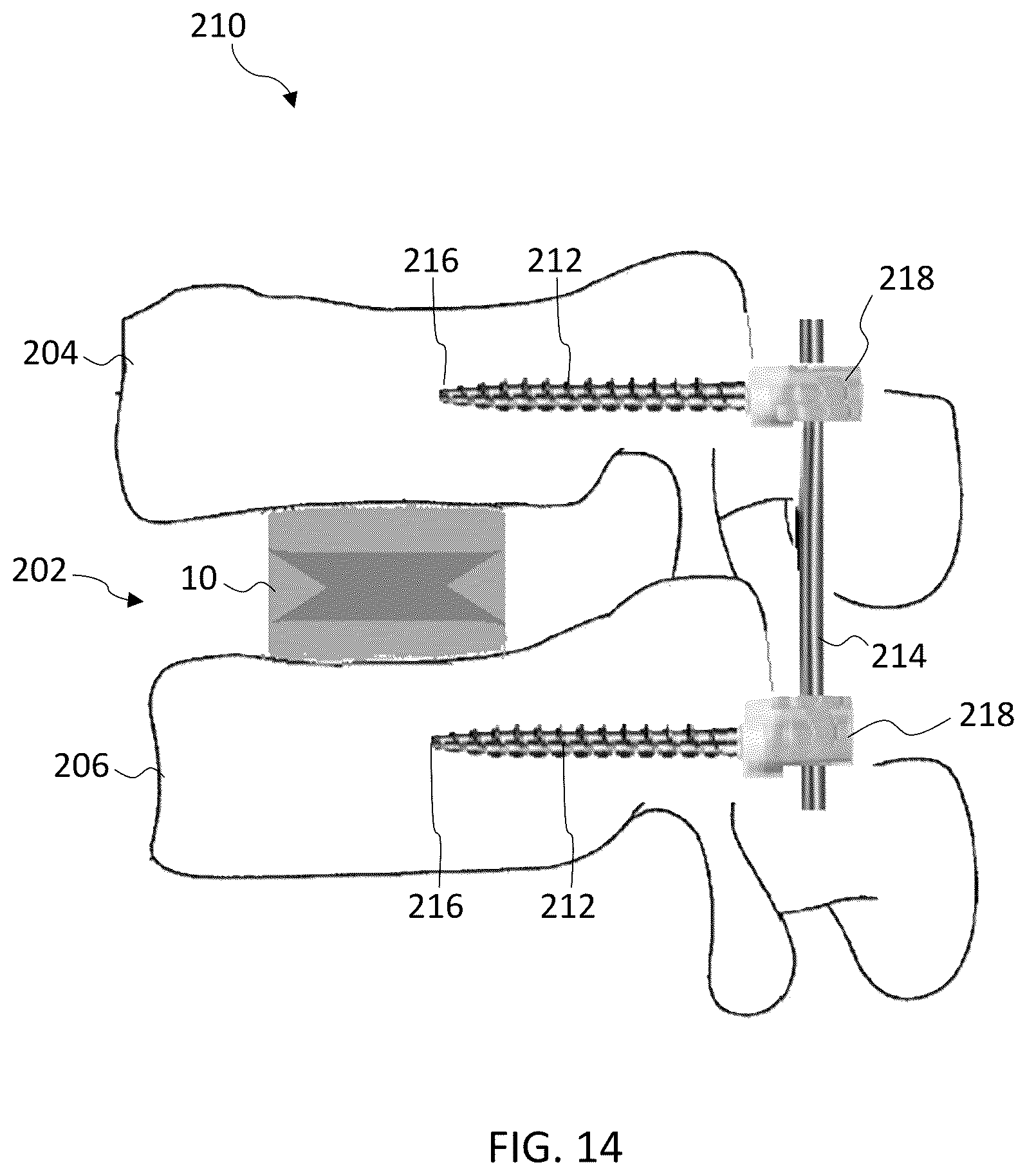 Patent US12403017 Figure 13 – Expandable footprint implant