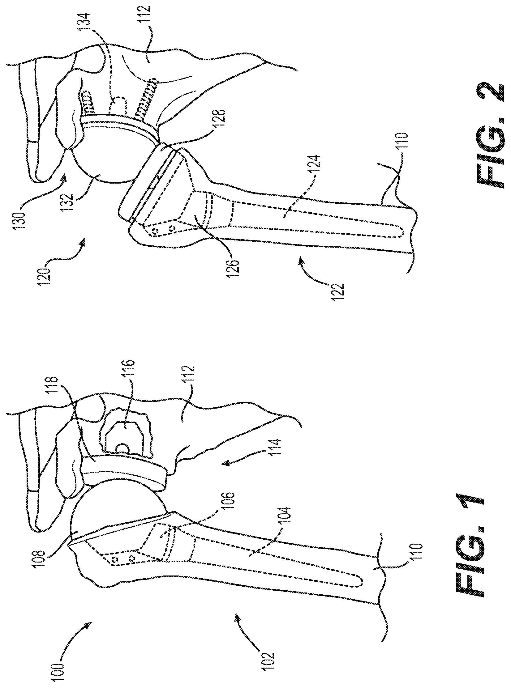 Patent US12403022 — Measurement system configured to support installation of a ball and socket joint and method therefor — Figure 1