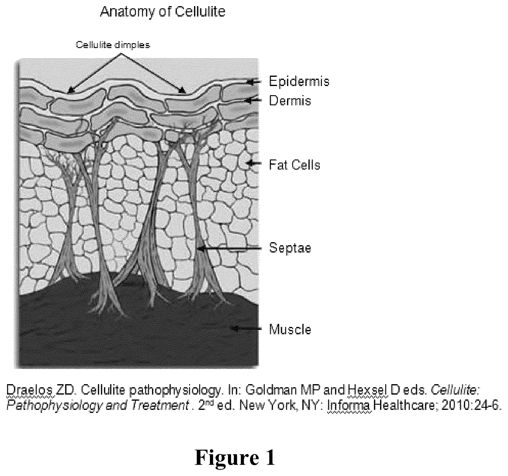 Patent US12403081 Figure 1 – Method of assessing and treating cellulite