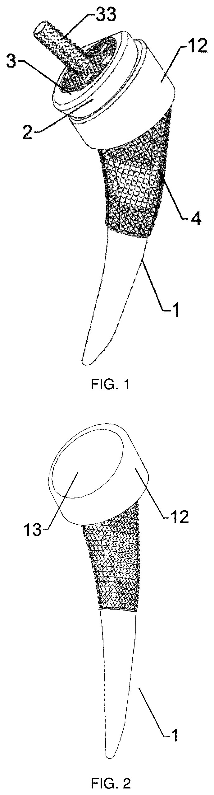 Patent US12403215 — Oxide layer-containing zirconium-niobium alloy shoulder joint prosthesis system and preparation method — Figure 1