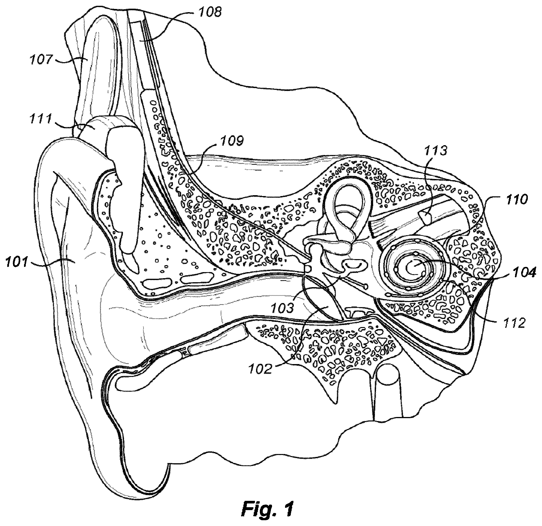 Patent US12403310 — Medial olivocochlear reflex sound coding with bandwidth normalization — Figure 1