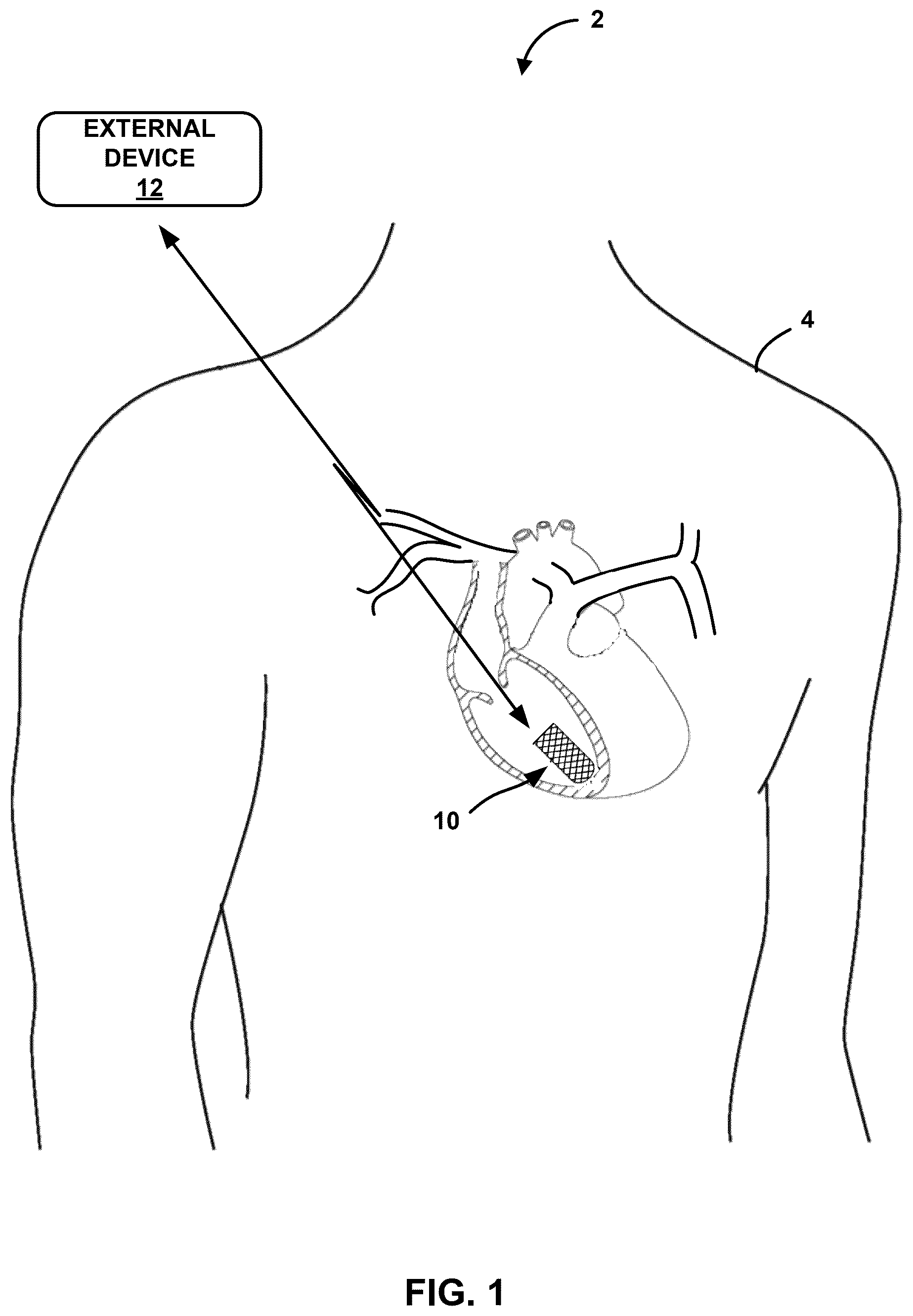 Patent US12403318 — Ceramic enclosure for rechargeable medical devices — Figure 1