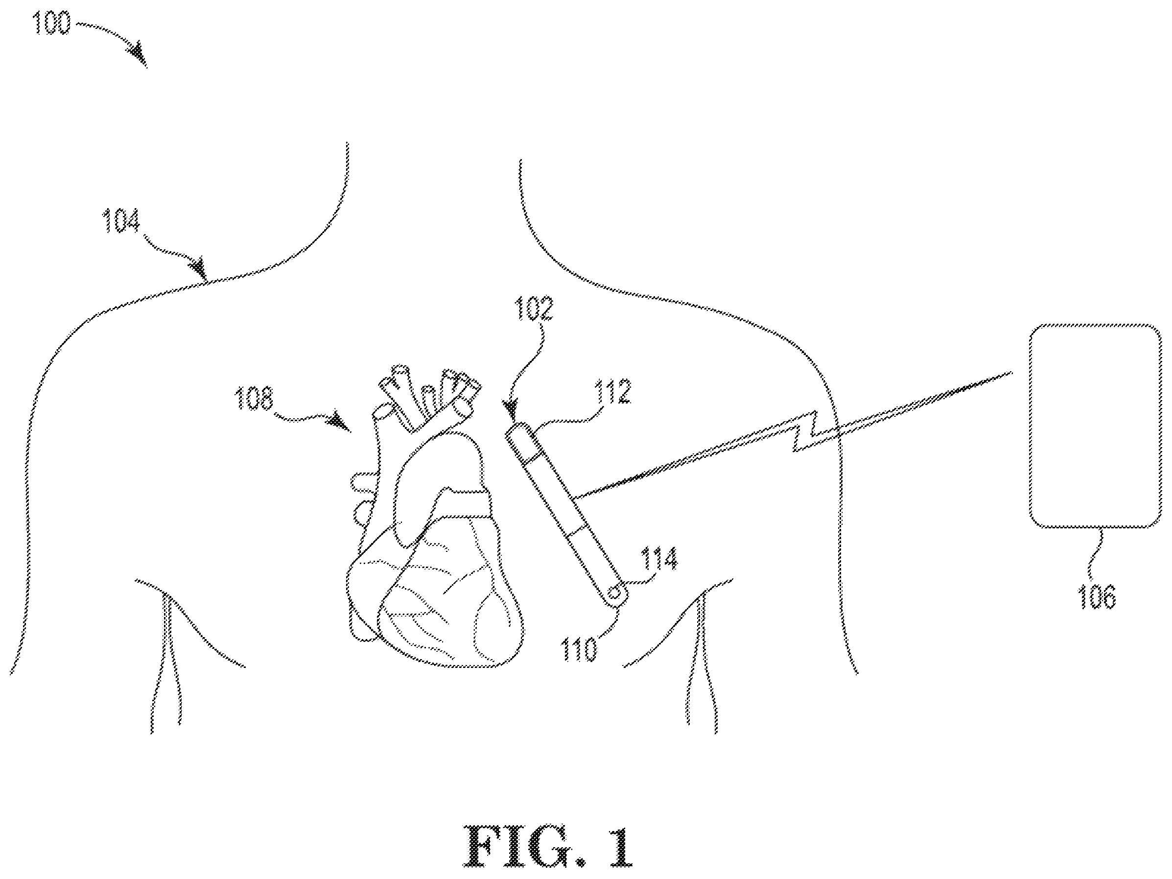Patent US12403321 — Case driven design for implantable medical device — Figure 1