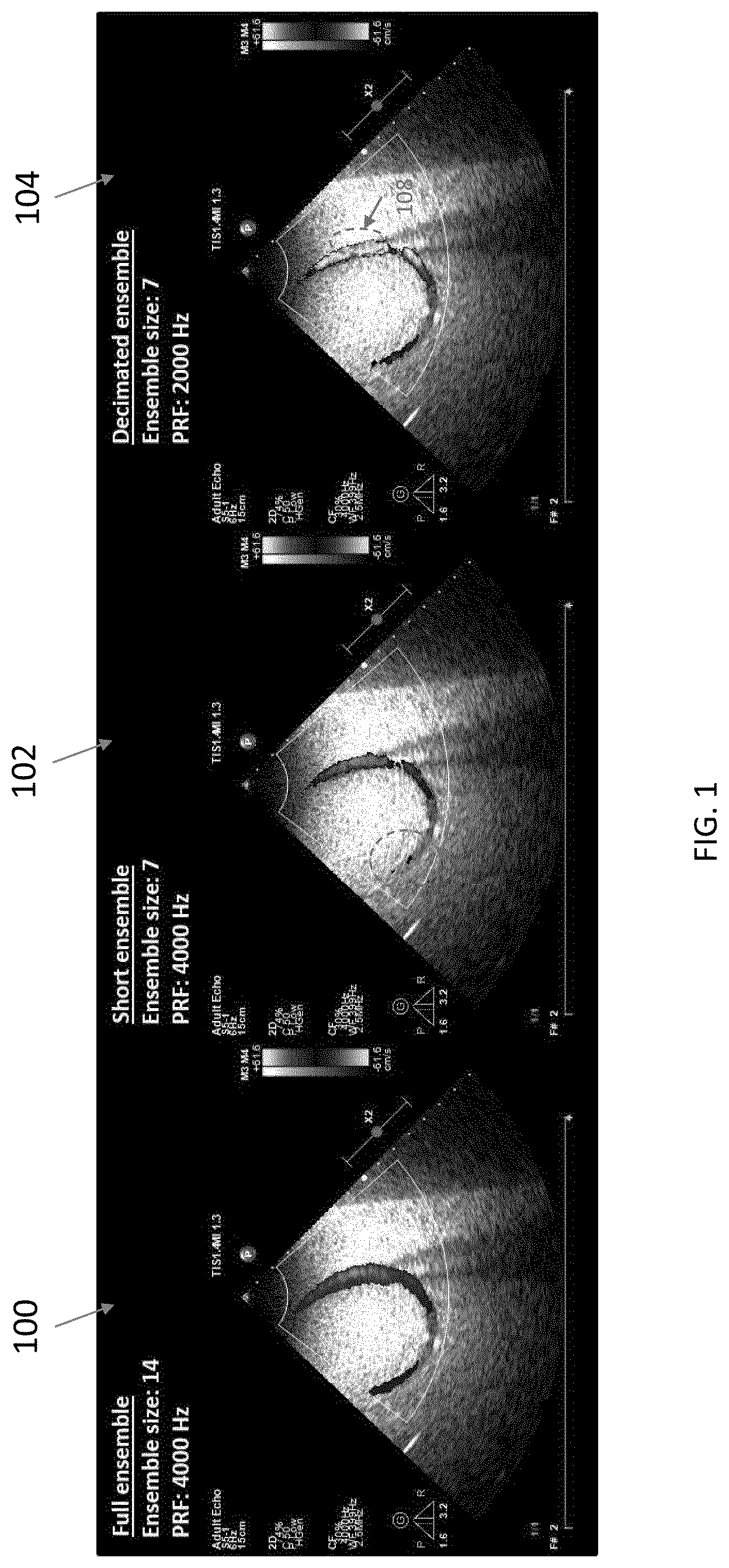 Patent US12422548 Figure 1 – Systems and methods for generating color doppler images from short and undersampled ensembles
