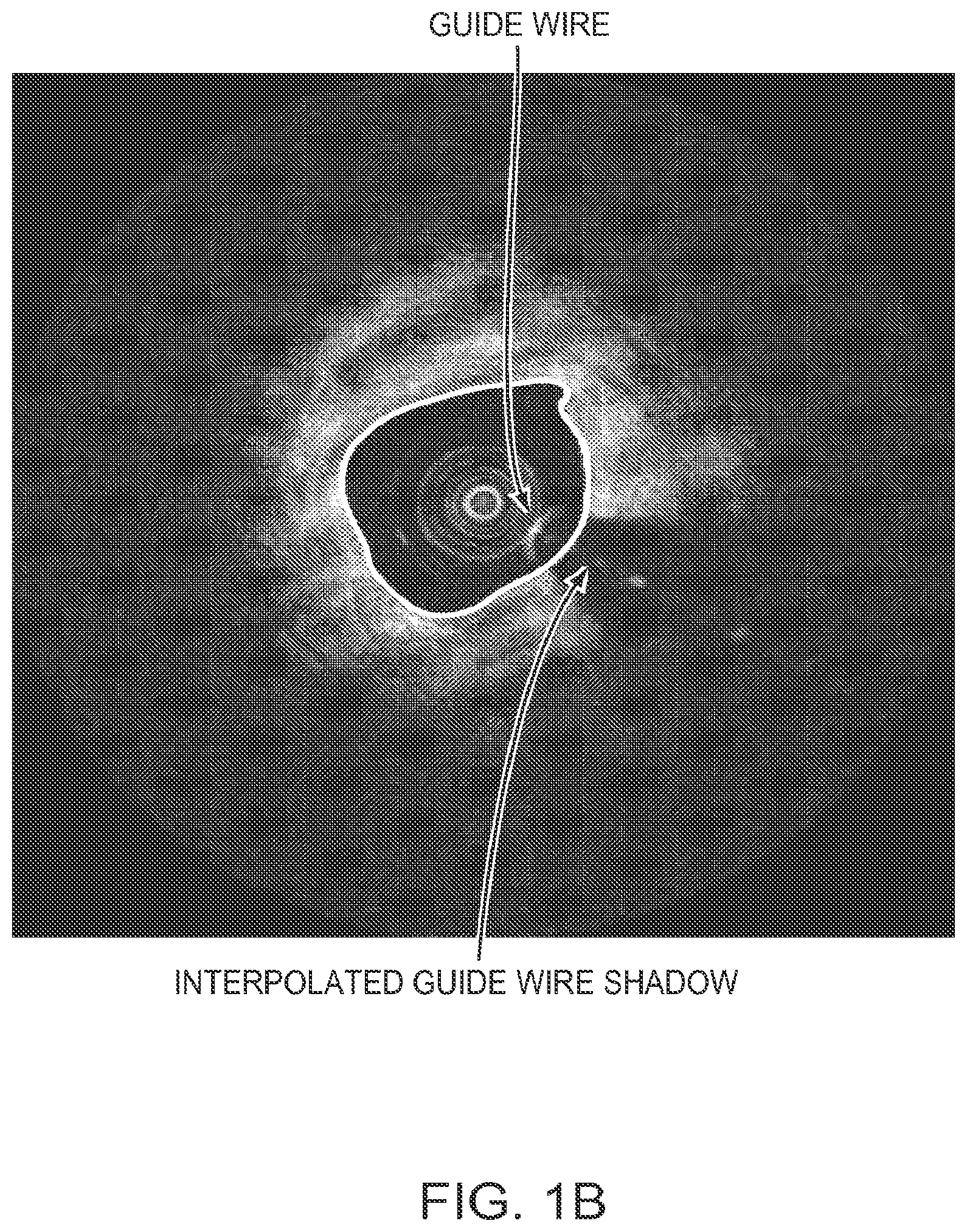 Patent US12426789 Figure 2 – Blood vessel lumen morphology and minimum lumen area measurements data collection by intravascular imaging systems for stenosis or stent planning
