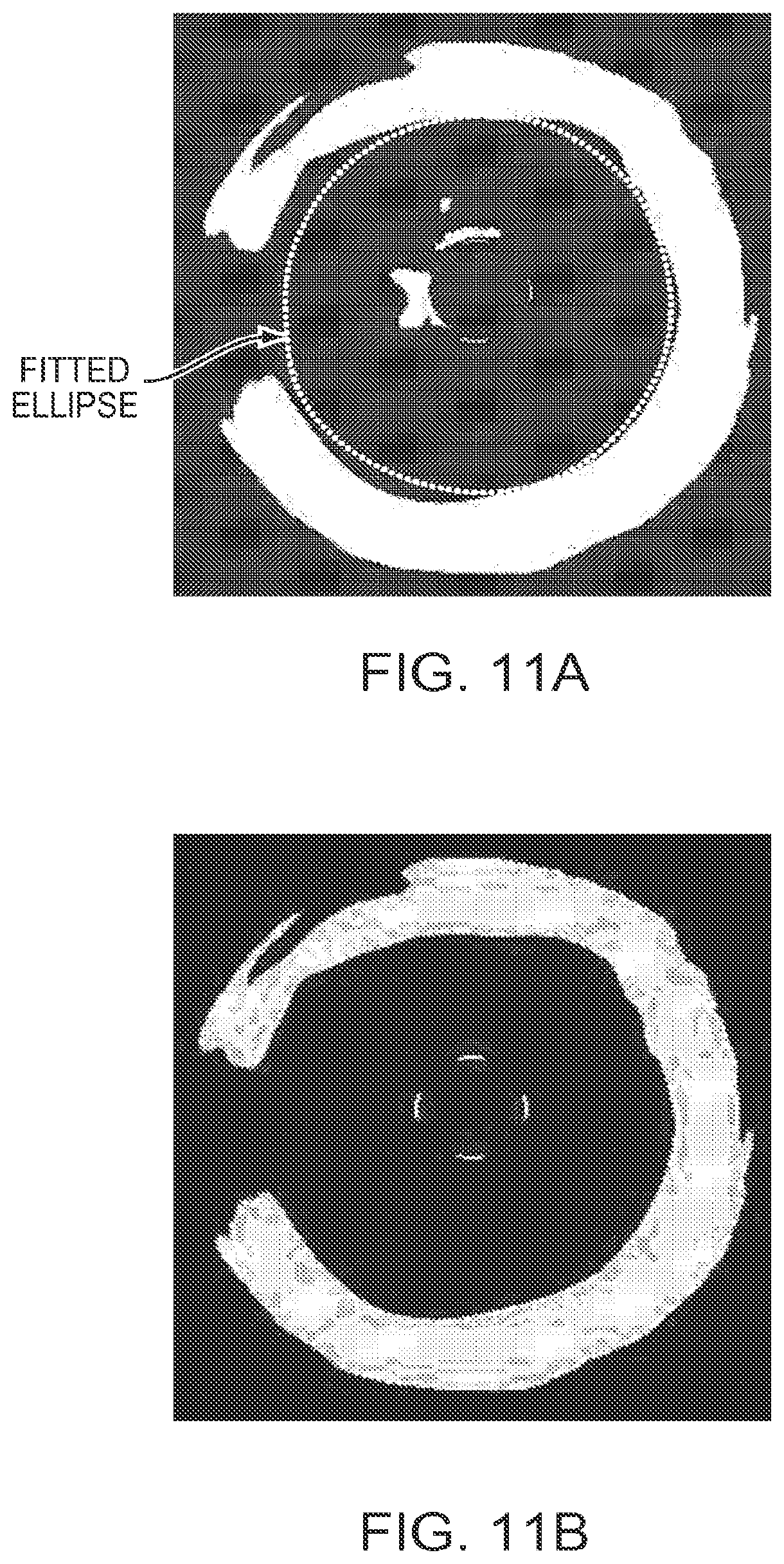 Patent US12426789 Figure 10 – Blood vessel lumen morphology and minimum lumen area measurements data collection by intravascular imaging systems for stenosis or stent planning