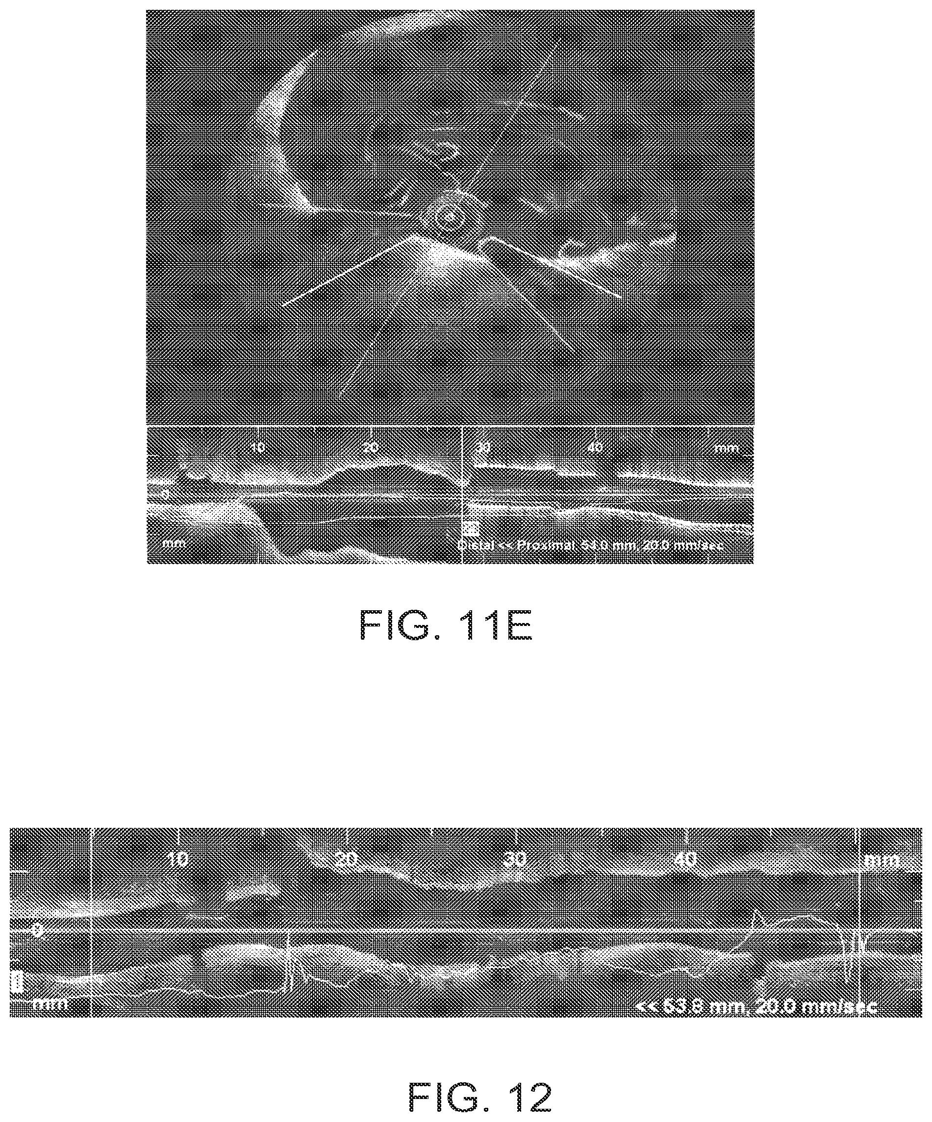 Patent US12426789 Figure 12 – Blood vessel lumen morphology and minimum lumen area measurements data collection by intravascular imaging systems for stenosis or stent planning