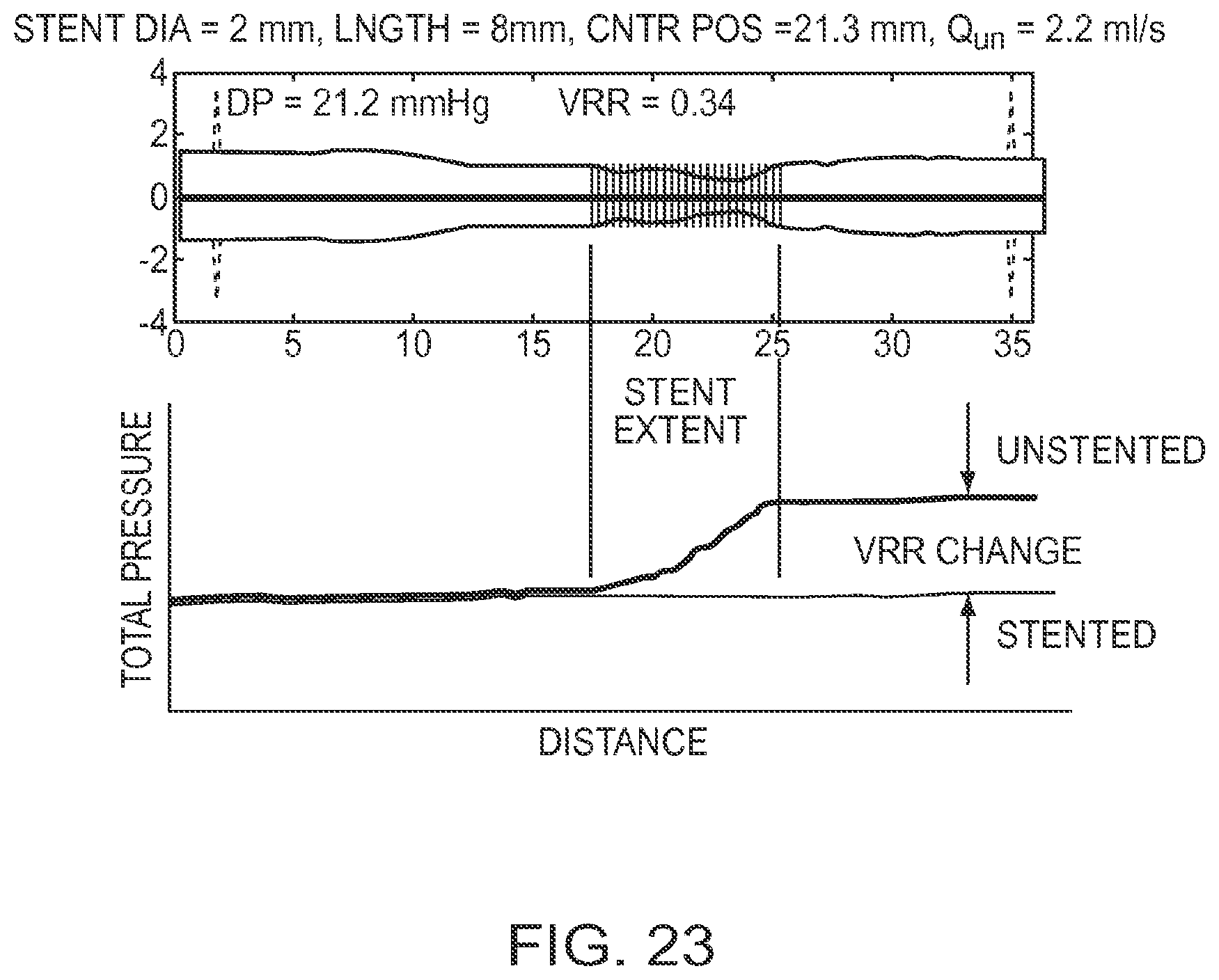 Patent US12426789 Figure 20 – Blood vessel lumen morphology and minimum lumen area measurements data collection by intravascular imaging systems for stenosis or stent planning