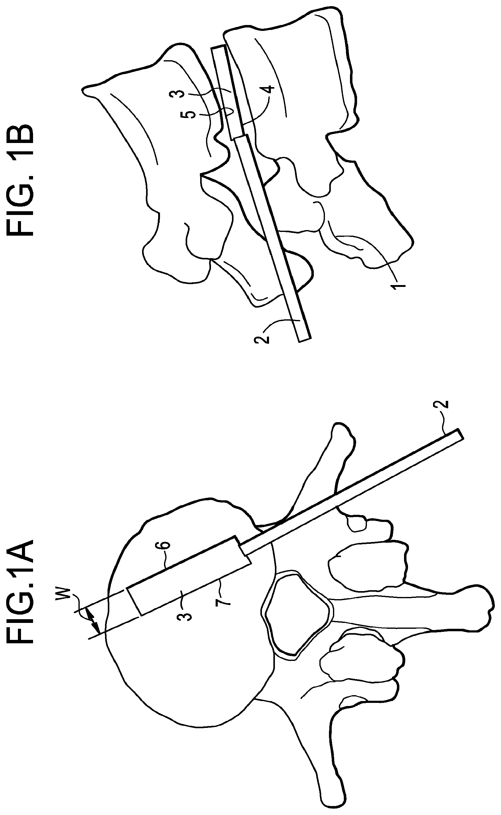 Patent US12426868 — Balloon with shape control for spinal procedures — Figure 1