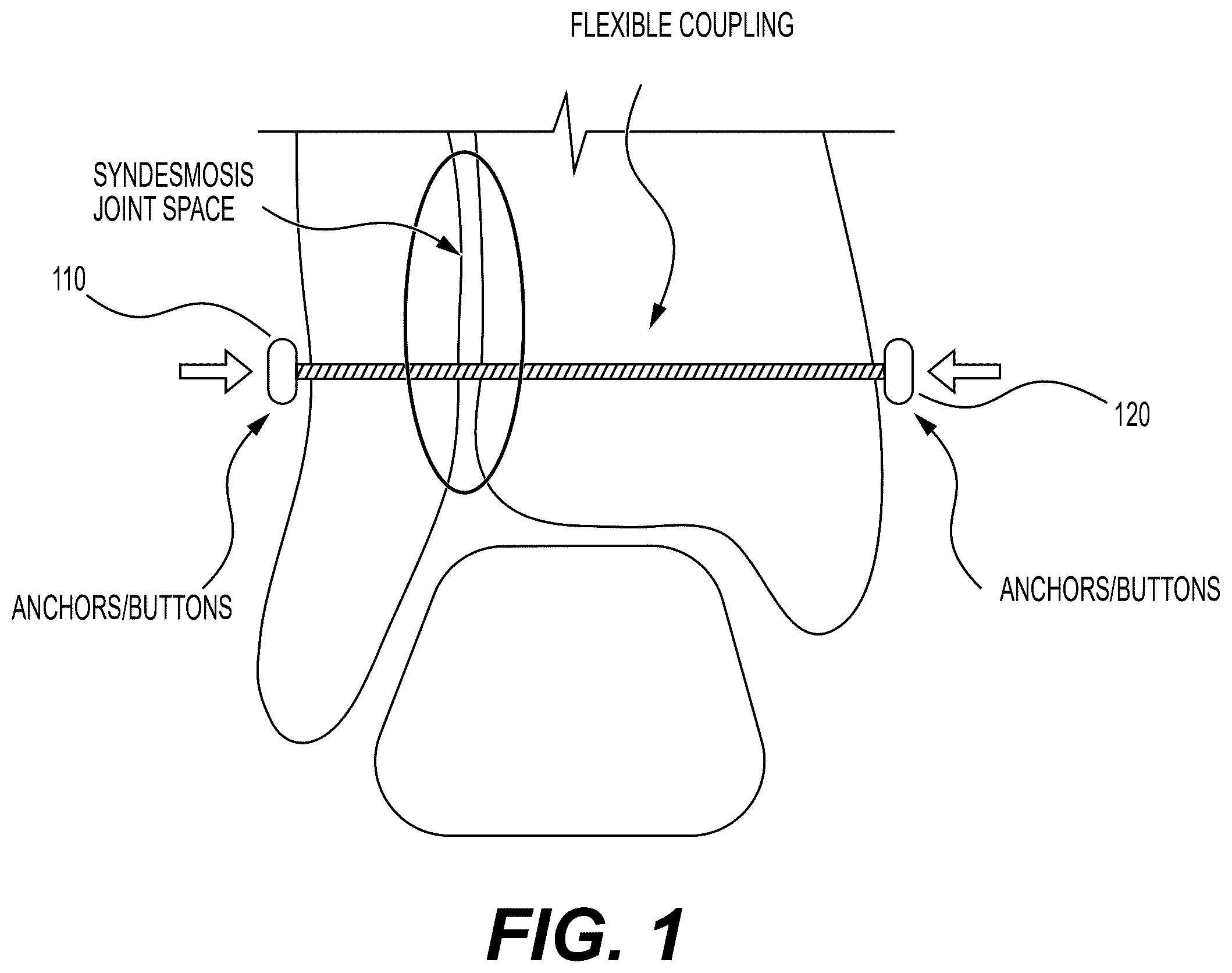 Patent US12426871 — Systems, devices and methods for implanting suture buttons — Figure 1