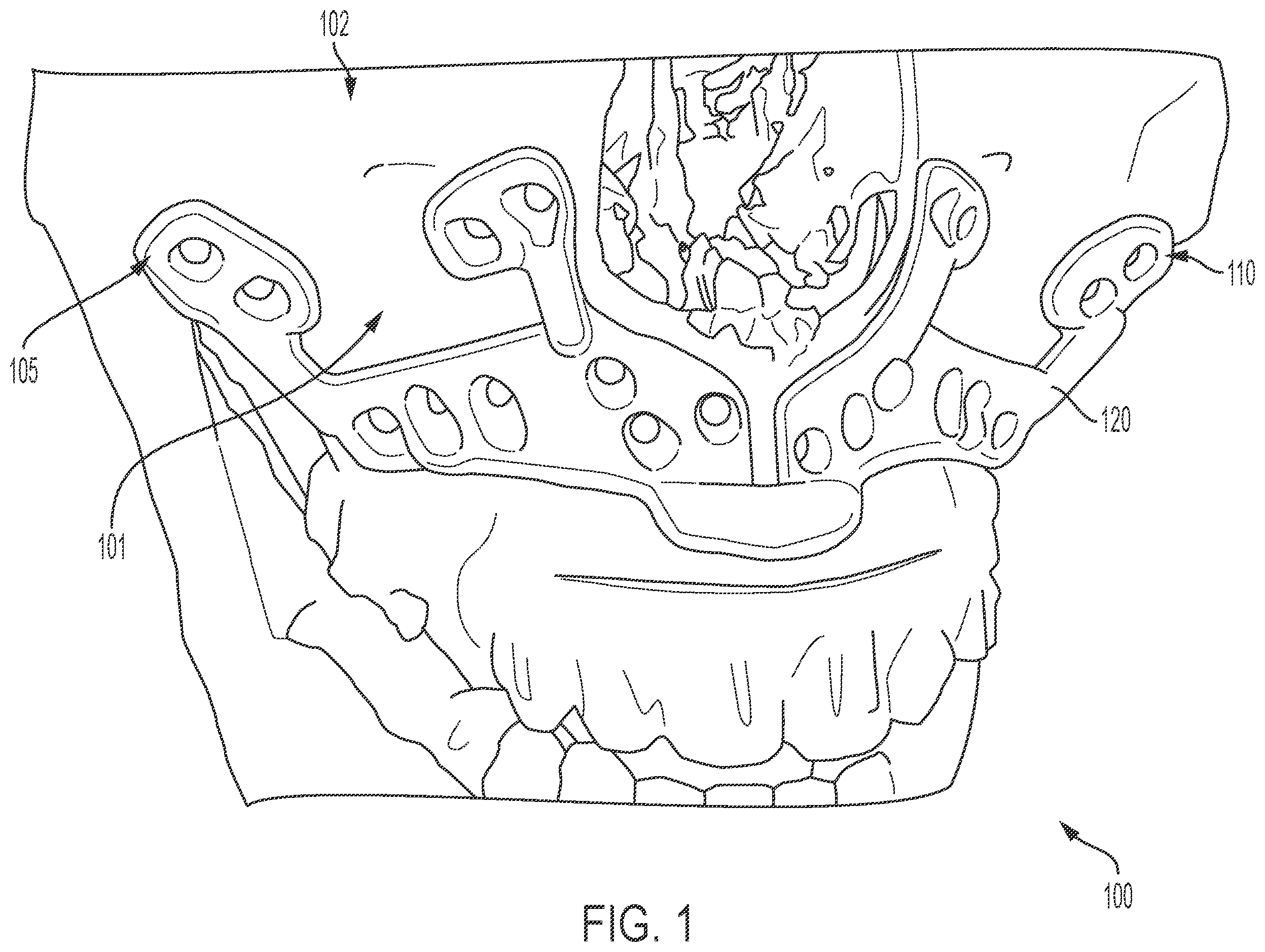 Patent US12426902 — Surgical cutting guides designed for anatomical landmarks — Figure 1