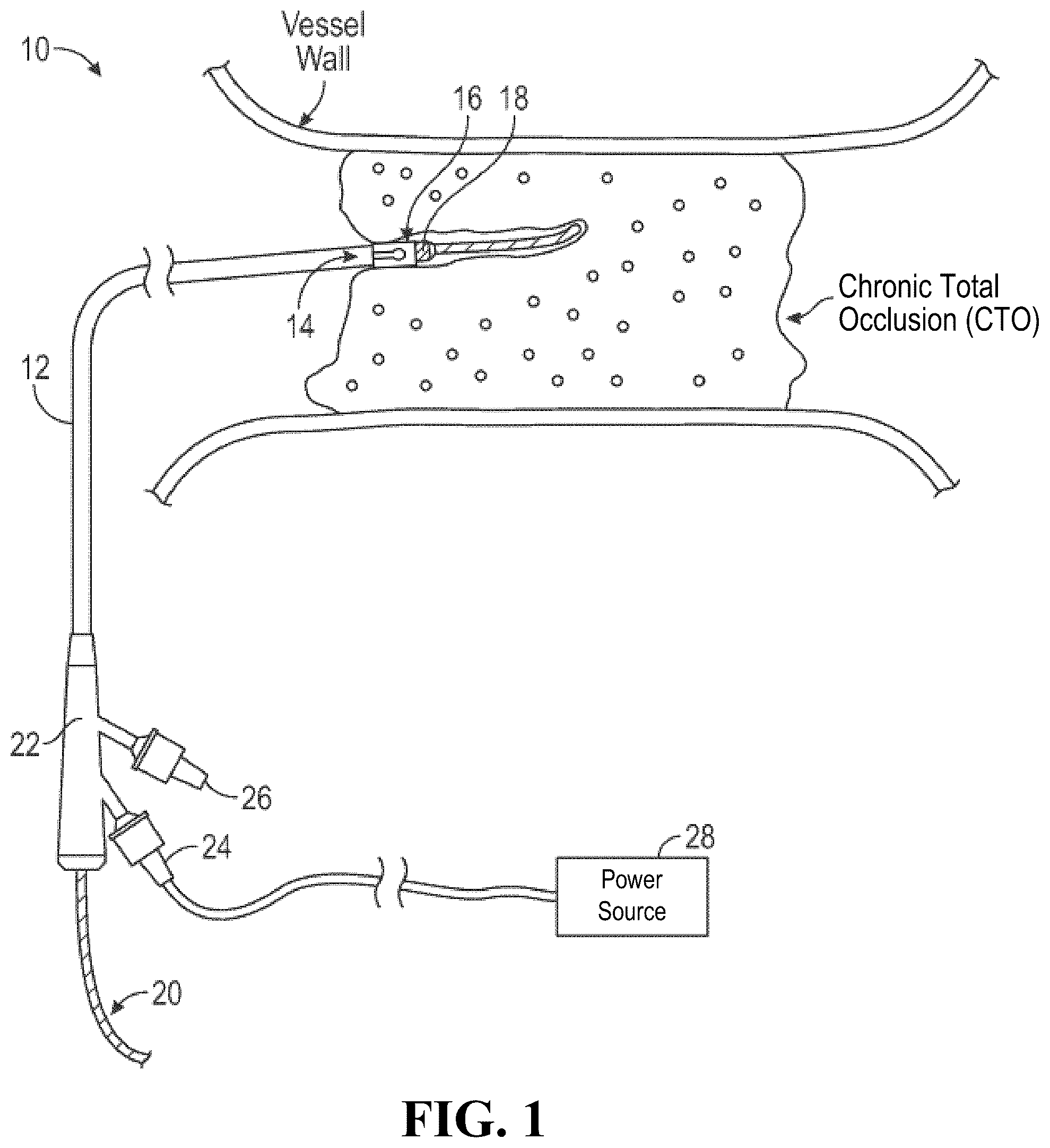 Patent US12426904 Figure 1 – Intravascular lithotripsy catheter with oscillating impactor