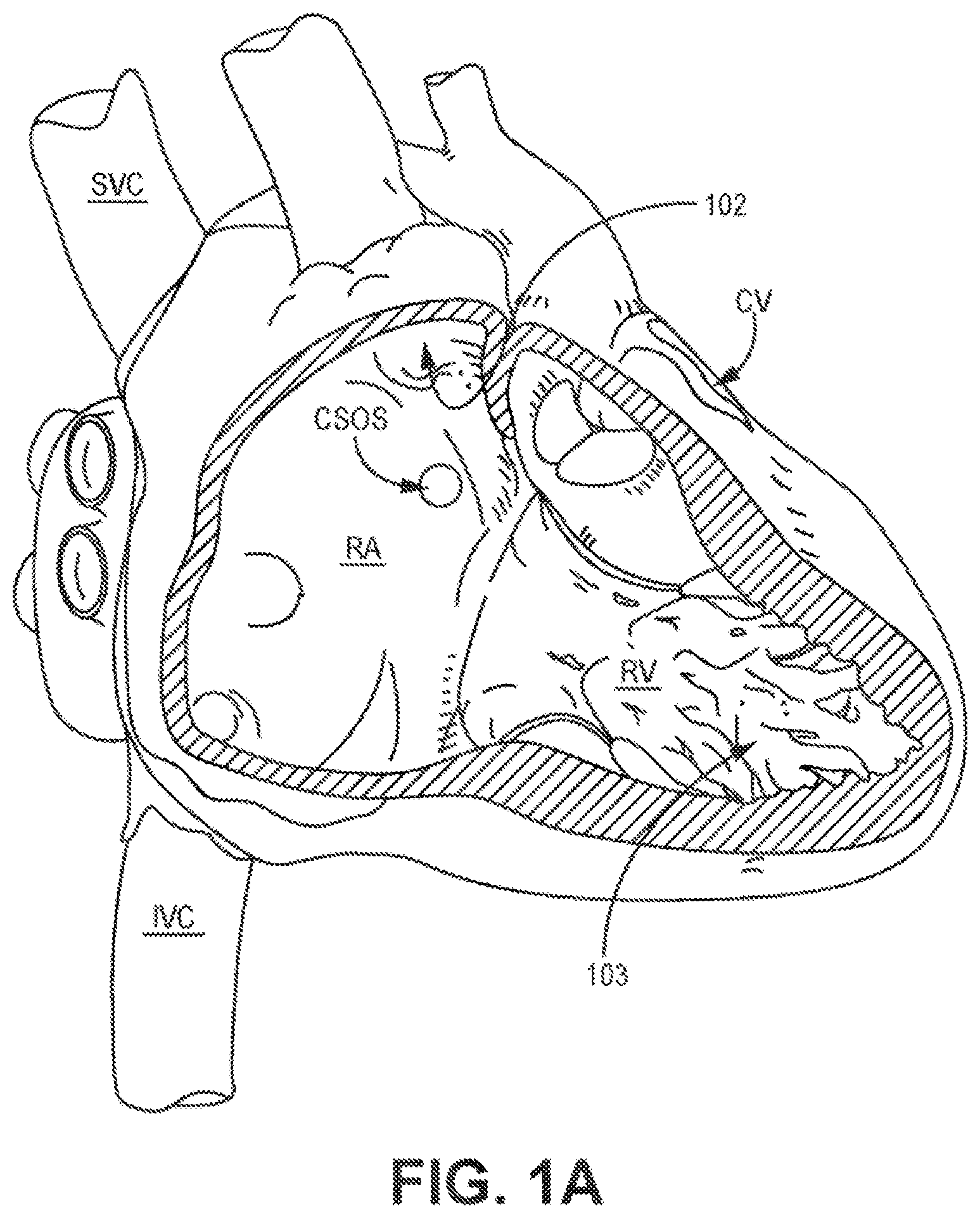 Patent US12426921 — Interventional medical systems and associated assemblies — Figure 1