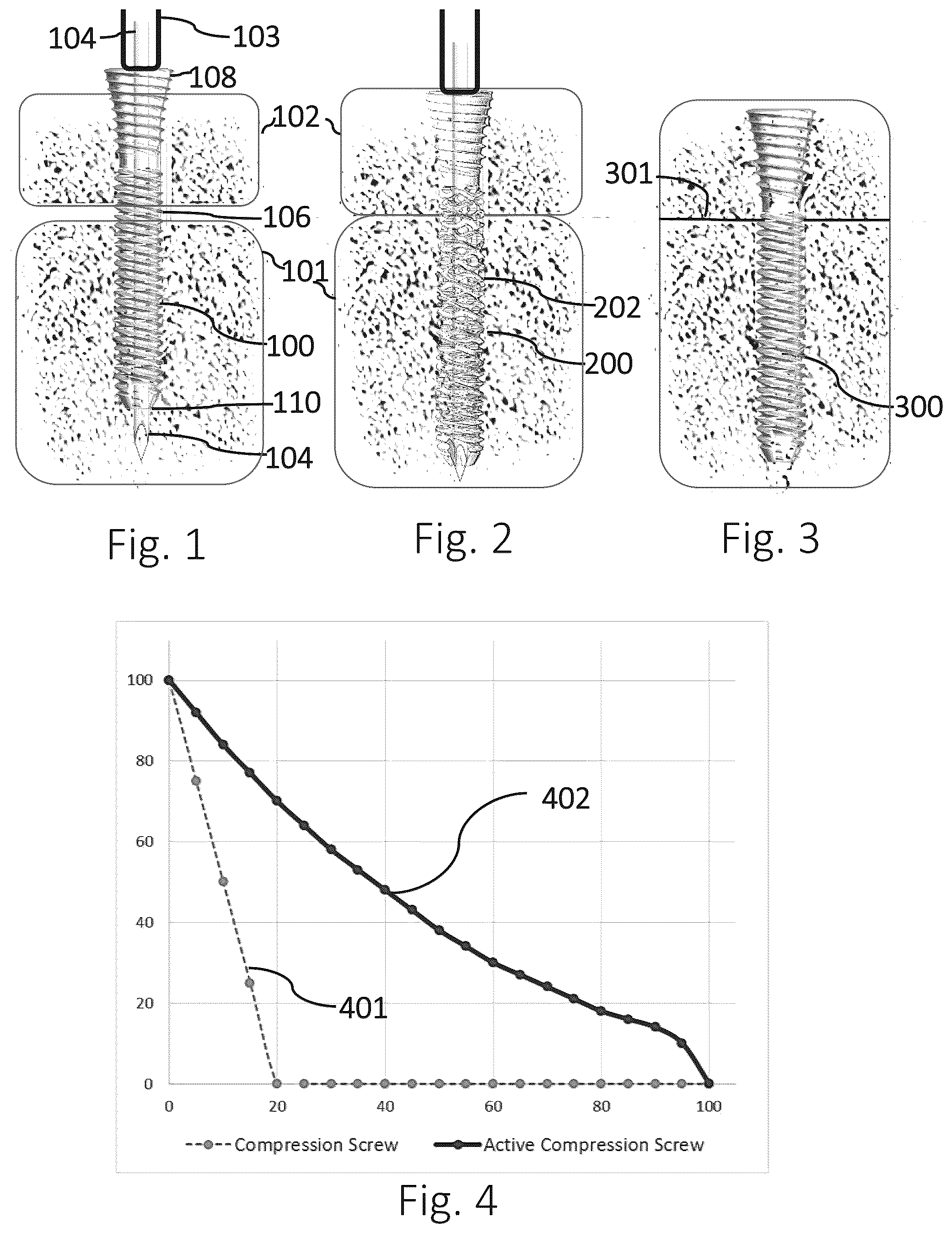 Patent US12426931 — Active compression apparatus, methods of assembly and methods of use — Figure 1