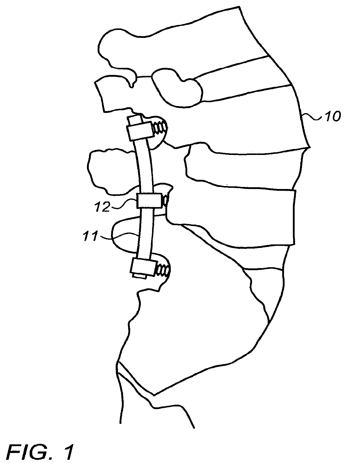 Patent US12426932 — Shaper for vertebral fixation rods — Figure 1