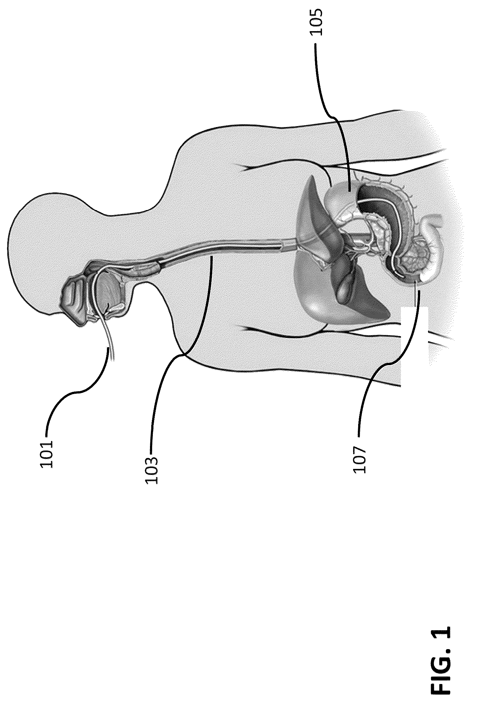 Patent US12426933 Figure 1 – Apparatus, systems and methods for soft tissue ablation