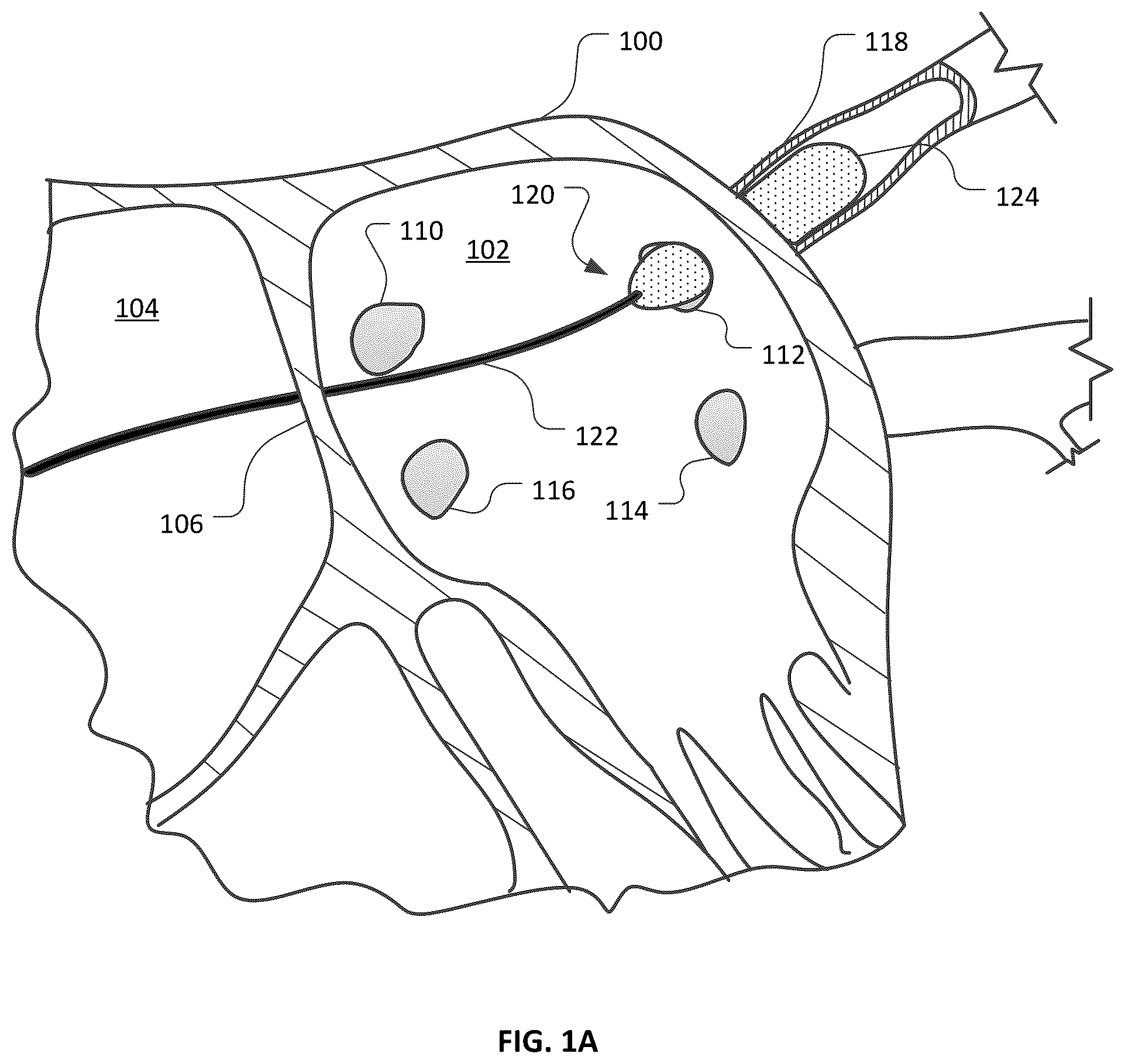 Patent US12426947 — Devices and methods for ablation of tissue — Figure 1