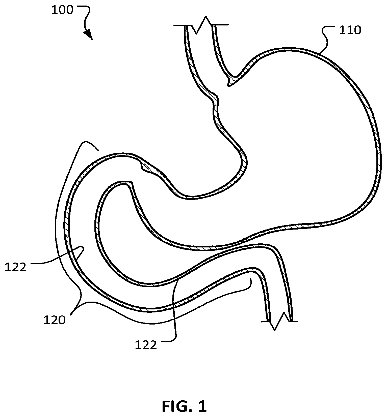 Patent US12426948 — Electroporation for obesity or diabetes treatment — Figure 1