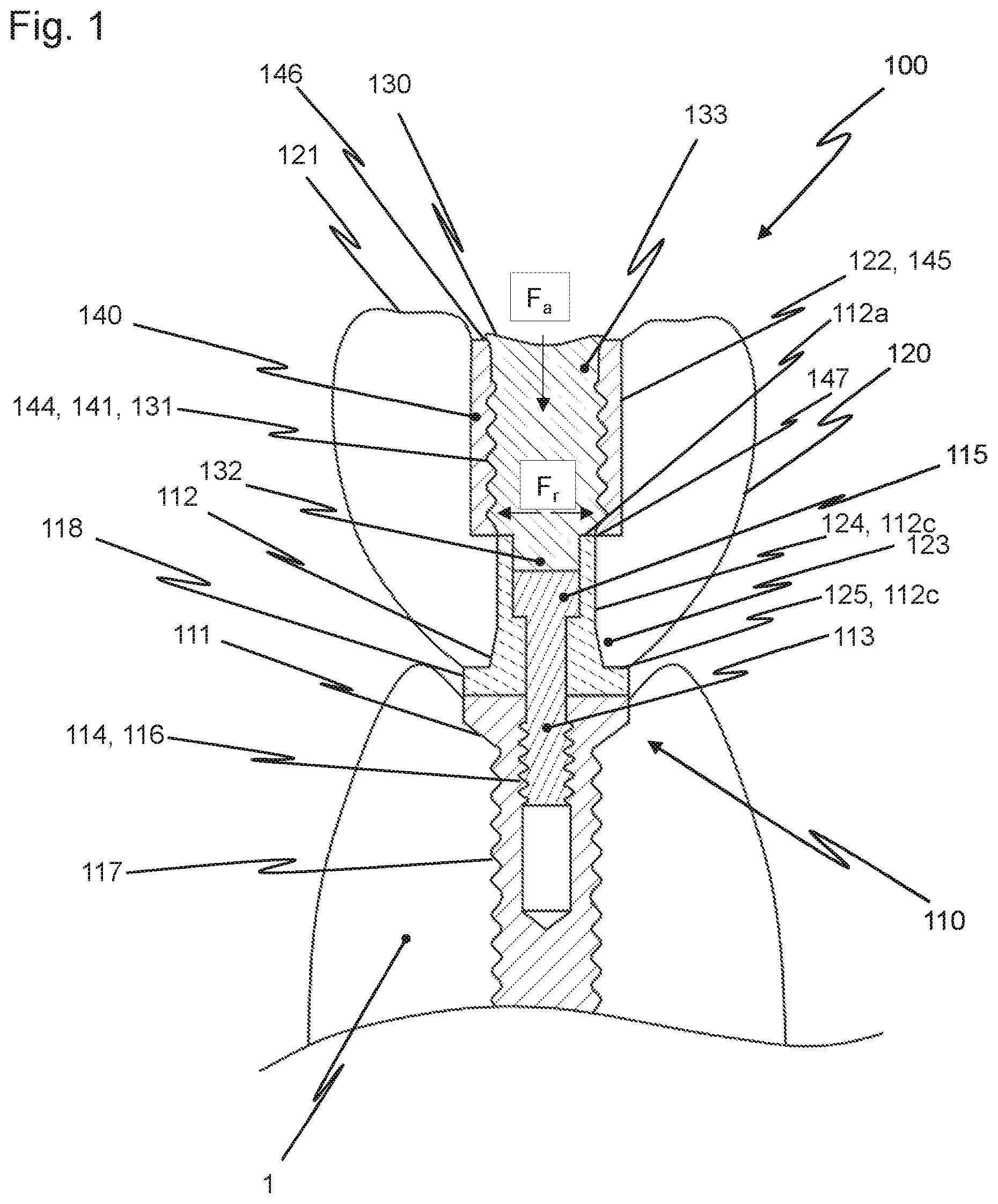 Patent US12426997 — Dental replacement having a connecting sleeve — Figure 1