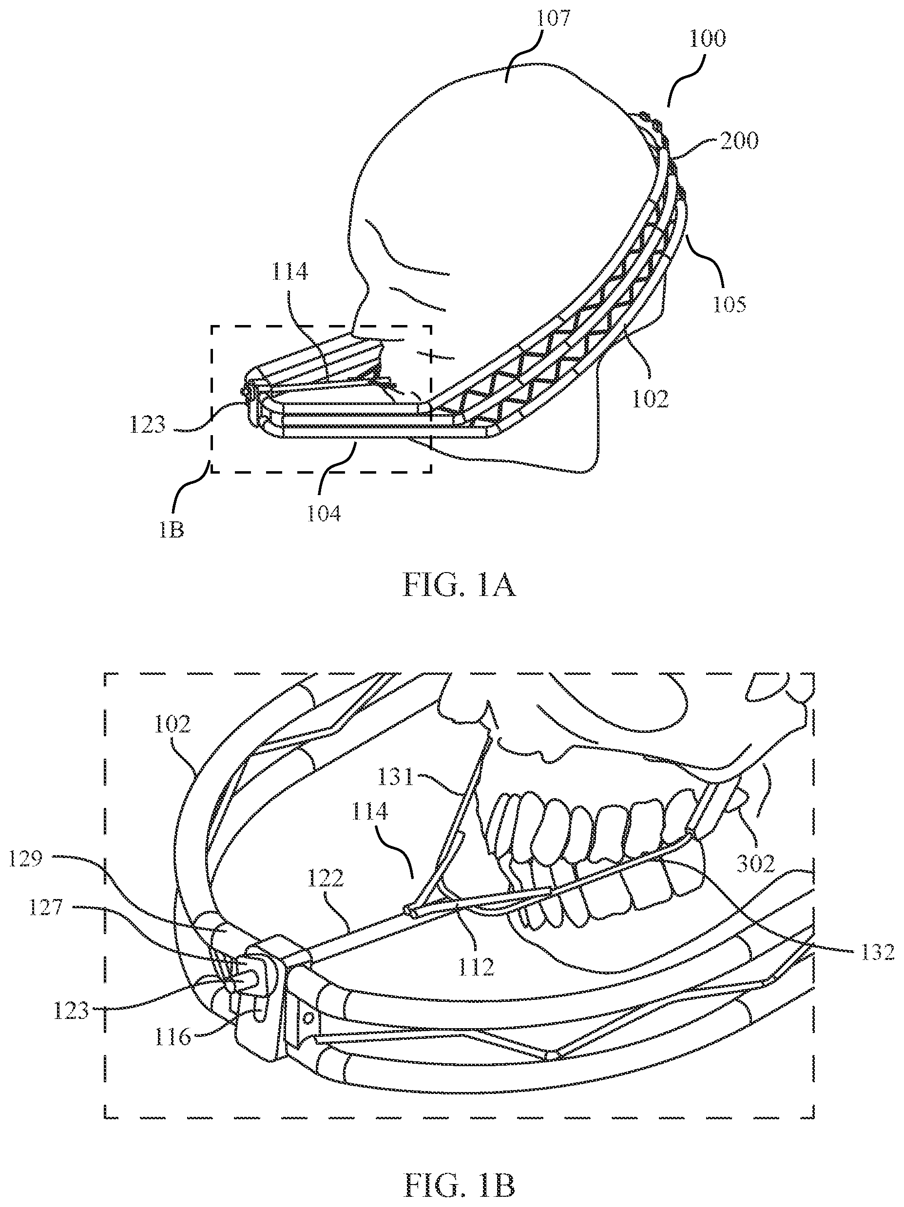 Patent US12472035 — Orthopedic device for midfacial bone structure advancement — Figure 1