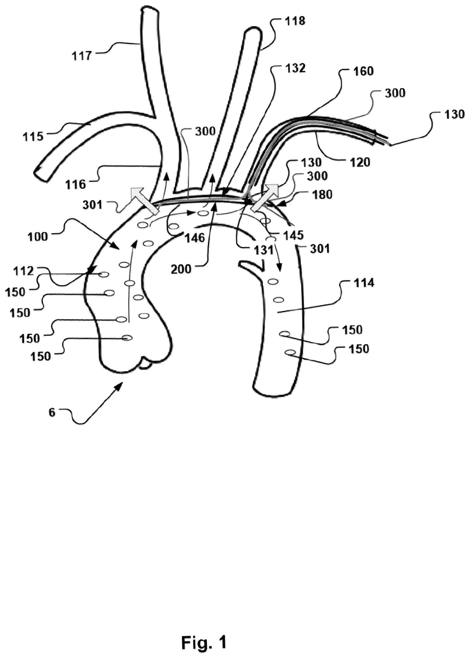 Patent US12472051 — Embolic protection device and method — Figure 1
