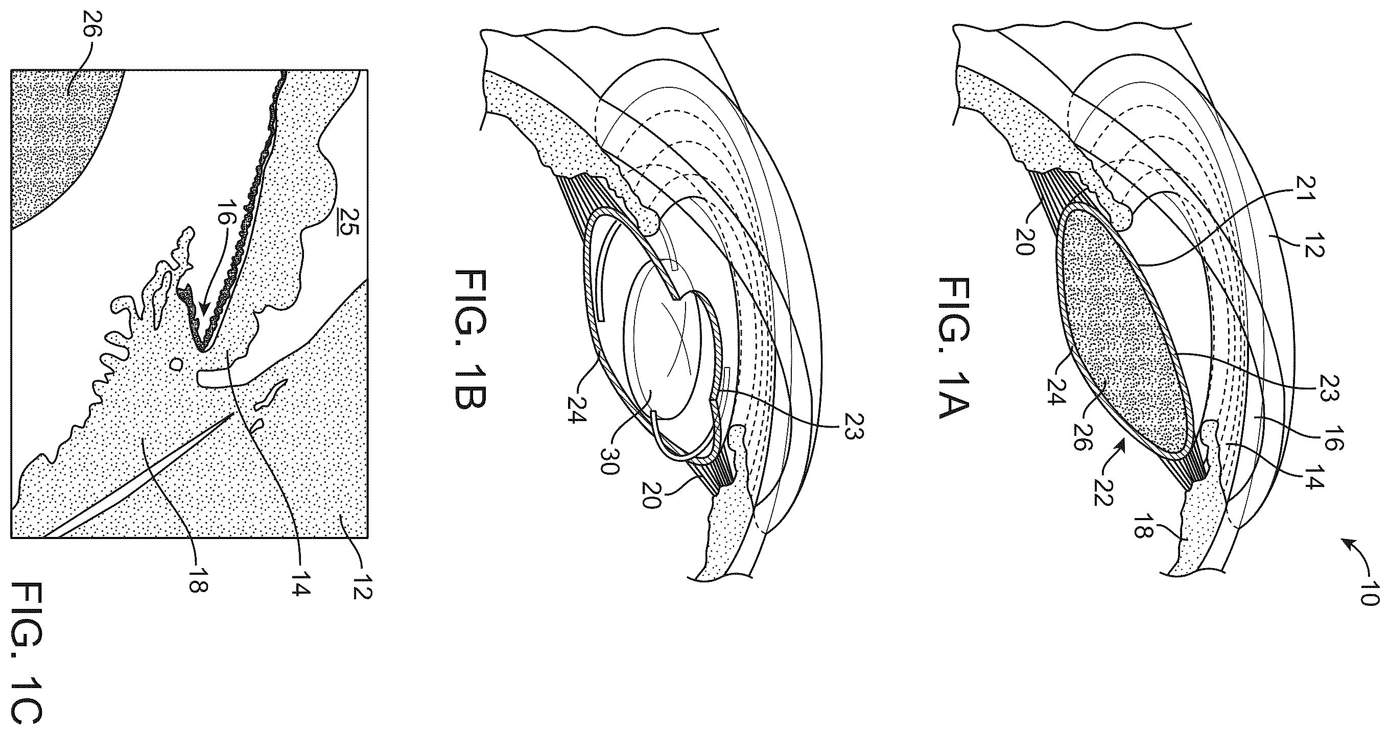 Patent US12472055 Figure 1 – Accommodating intraocular lens and methods of implantation