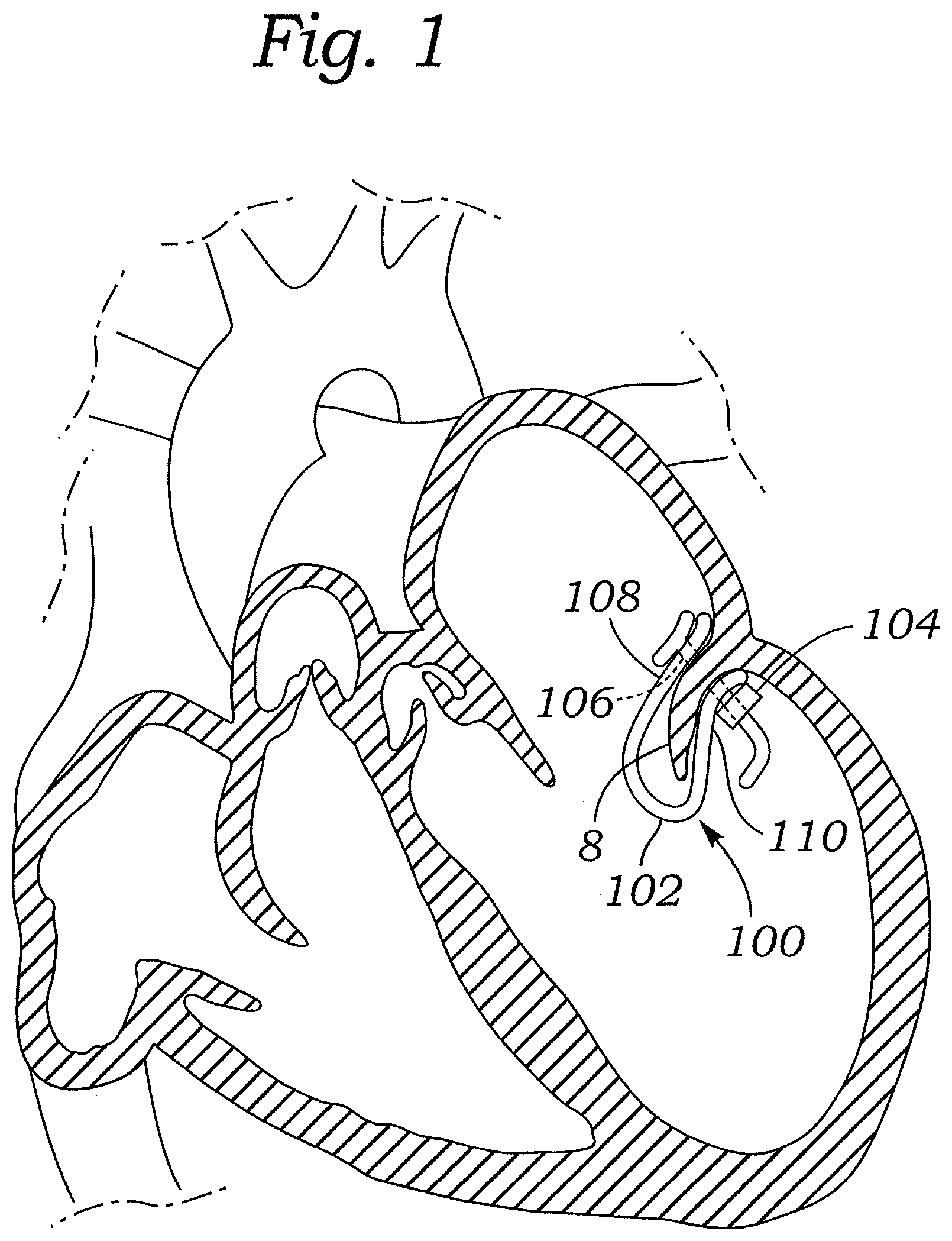 Patent US12472059 Figure 1 – Prosthetic heart valve docking assembly