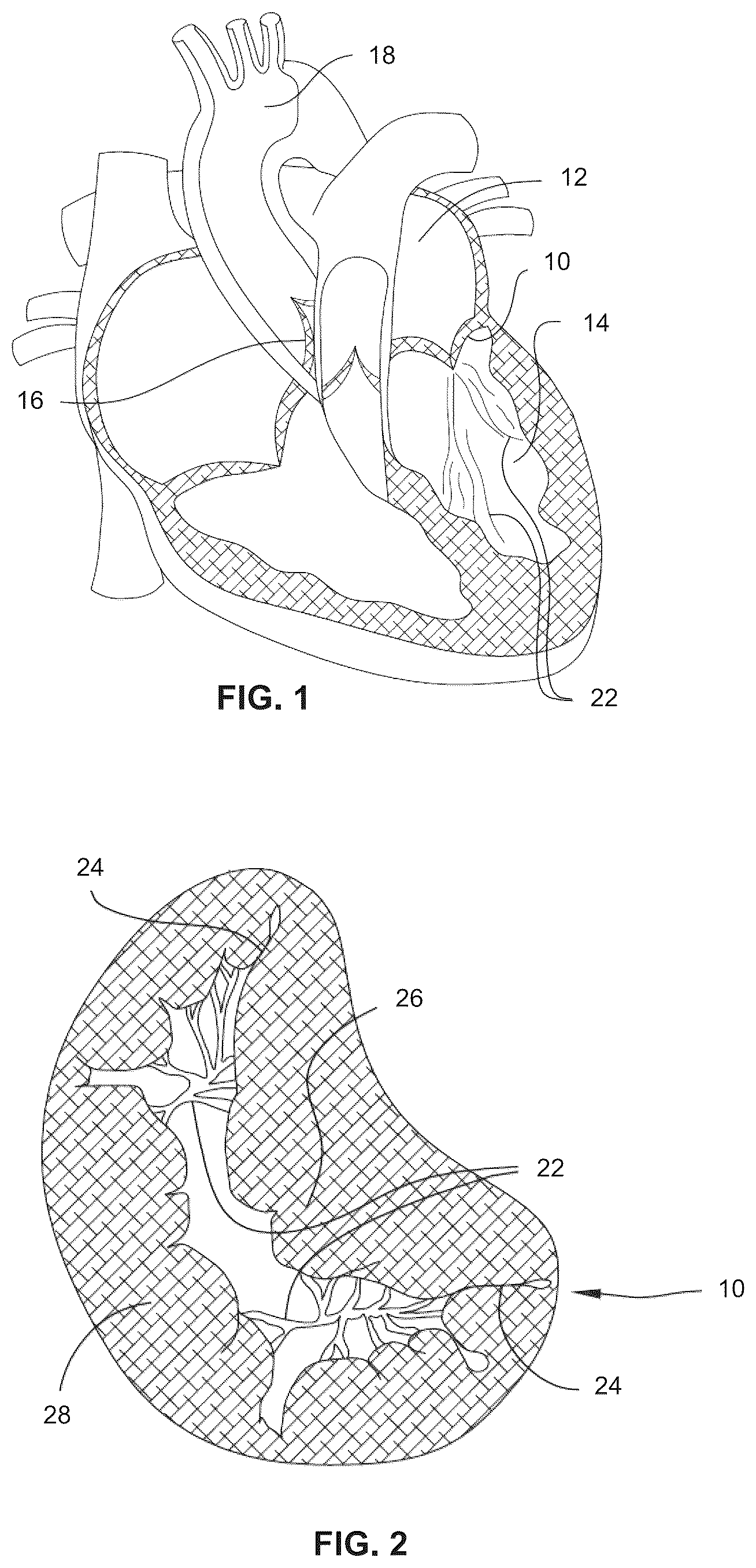 Patent US12472061 — Systems, devices, and methods for treating heart valves — Figure 1