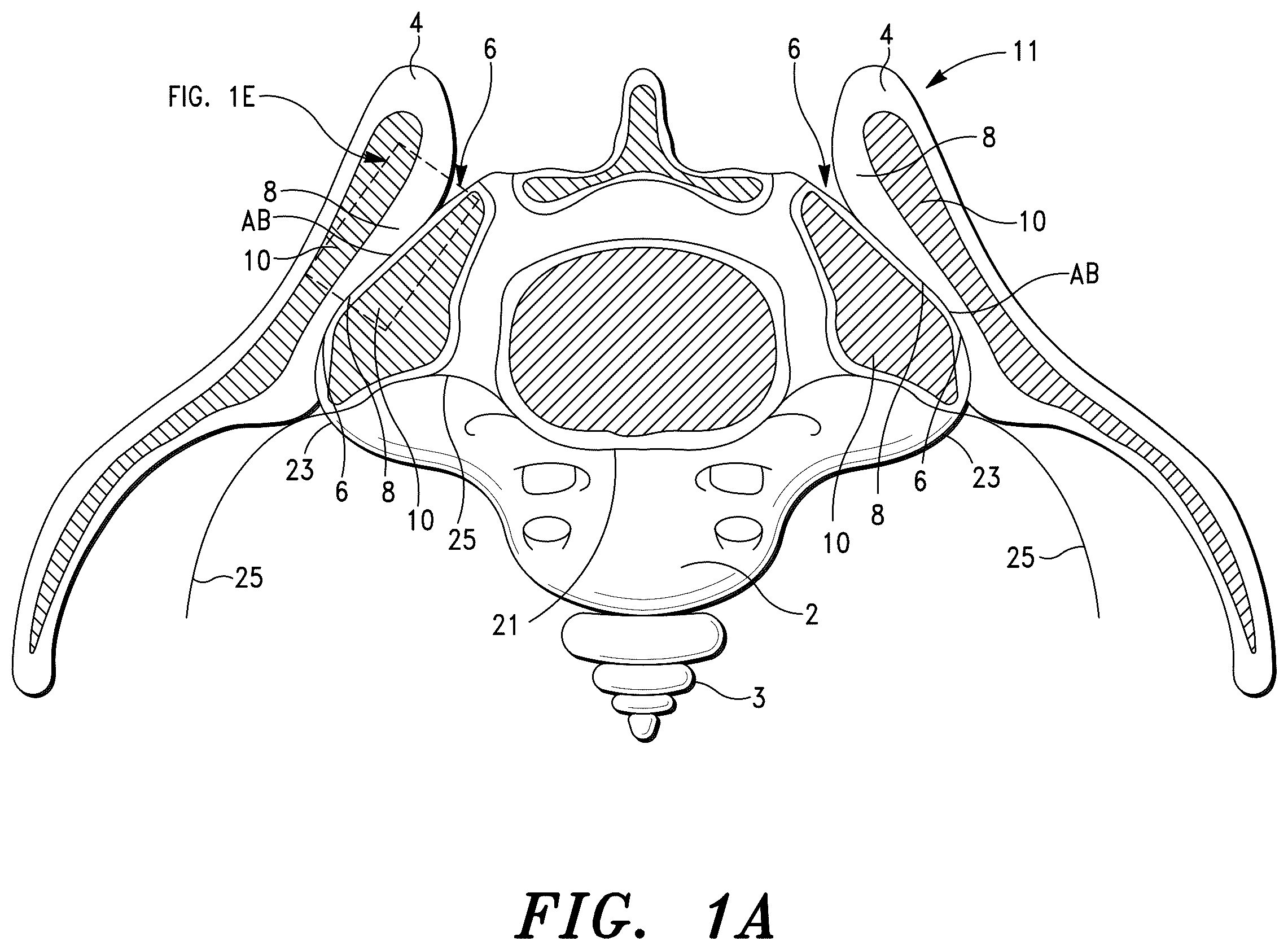 Patent US12472069 — Methods for sacroiliac joint stabilization — Figure 1